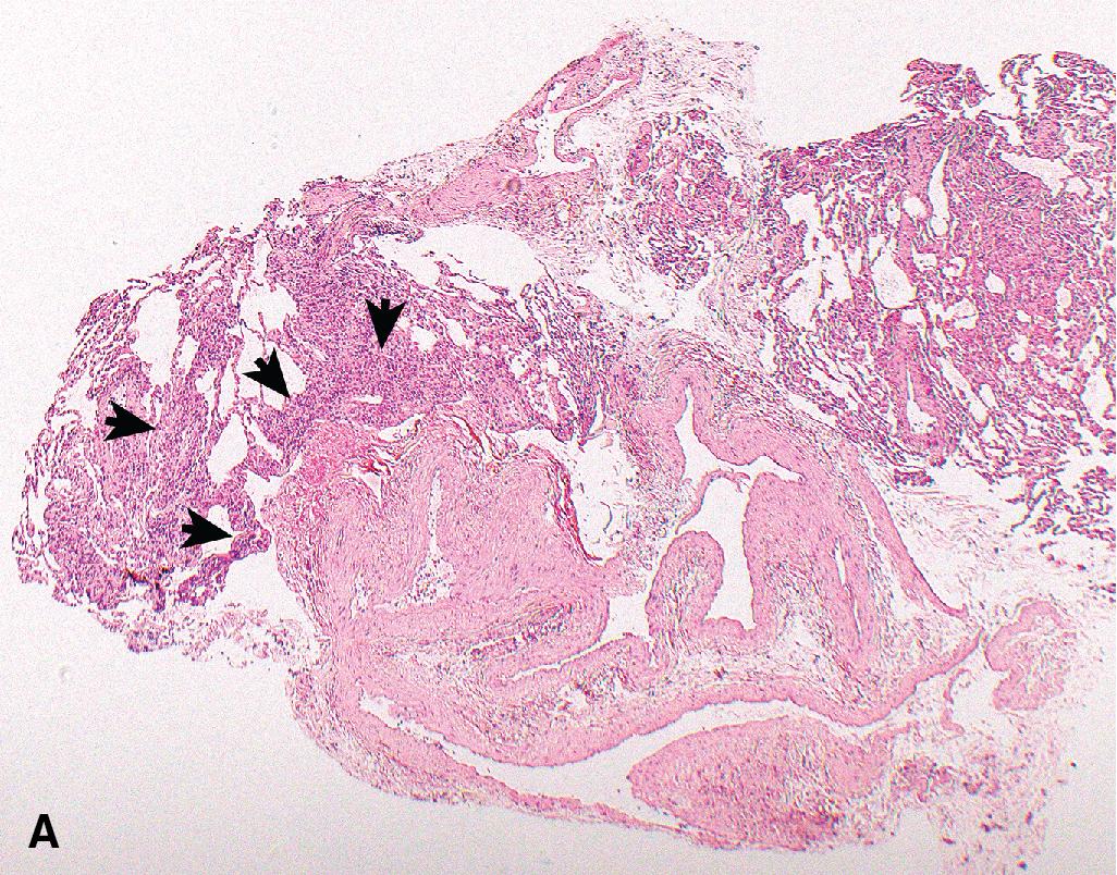 Figure 13.3, Moderate acute rejection (Grade A3). (A) Multiple foci of marked cellular infiltrates are apparent (arrows) . (B) The mononuclear cell infiltrate extends into the adjacent interalveolar septa (arrows) . (C) Occasional lymphocytes are interspersed with endothelial cells consistent with endothelialitis (arrow) . The mononuclear cell infiltrate is largely comprised of lymphocytes; scattered plasma cells (arrowheads) and macrophages (turquoise arrowhead) are also present. Magnification × 40 (A), × 200 (B), × 600 (C).