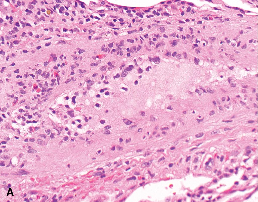 Figure 13.5, Endothelialitis in high-grade acute rejection. (A) A vessel is rimmed by a mononuclear cell infiltrate with scattered eosinophils suggestive of high-grade acute rejection. (B) The mononuclear cells infiltrate the vessel wall with extension to the endothelial cell layer. Magnification × 400 (A), × 600 (B).