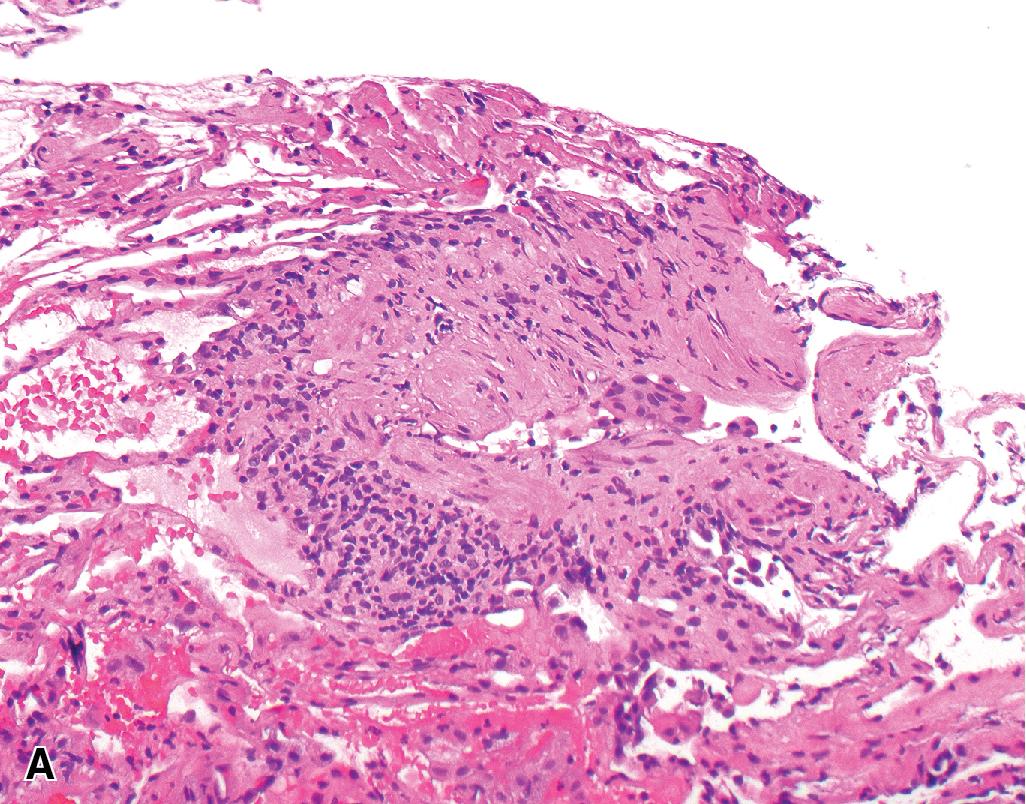 Figure 13.10, Obliterative bronchiolitis (Grade C1). (A) A small airway (note mucosa is sloughed off) shows submucosal fibrosis and is focally rimmed by a mononuclear cell infiltrate. (B) This Verhoeff-Van Gieson stain shows a different tissue level which reveals broadening of the submucosa due to a cluster of macrophages (denoted by *) . Mucosa (arrowheads) , elastic layer of the small airway (arrows). Magnification × 200 (A, B).