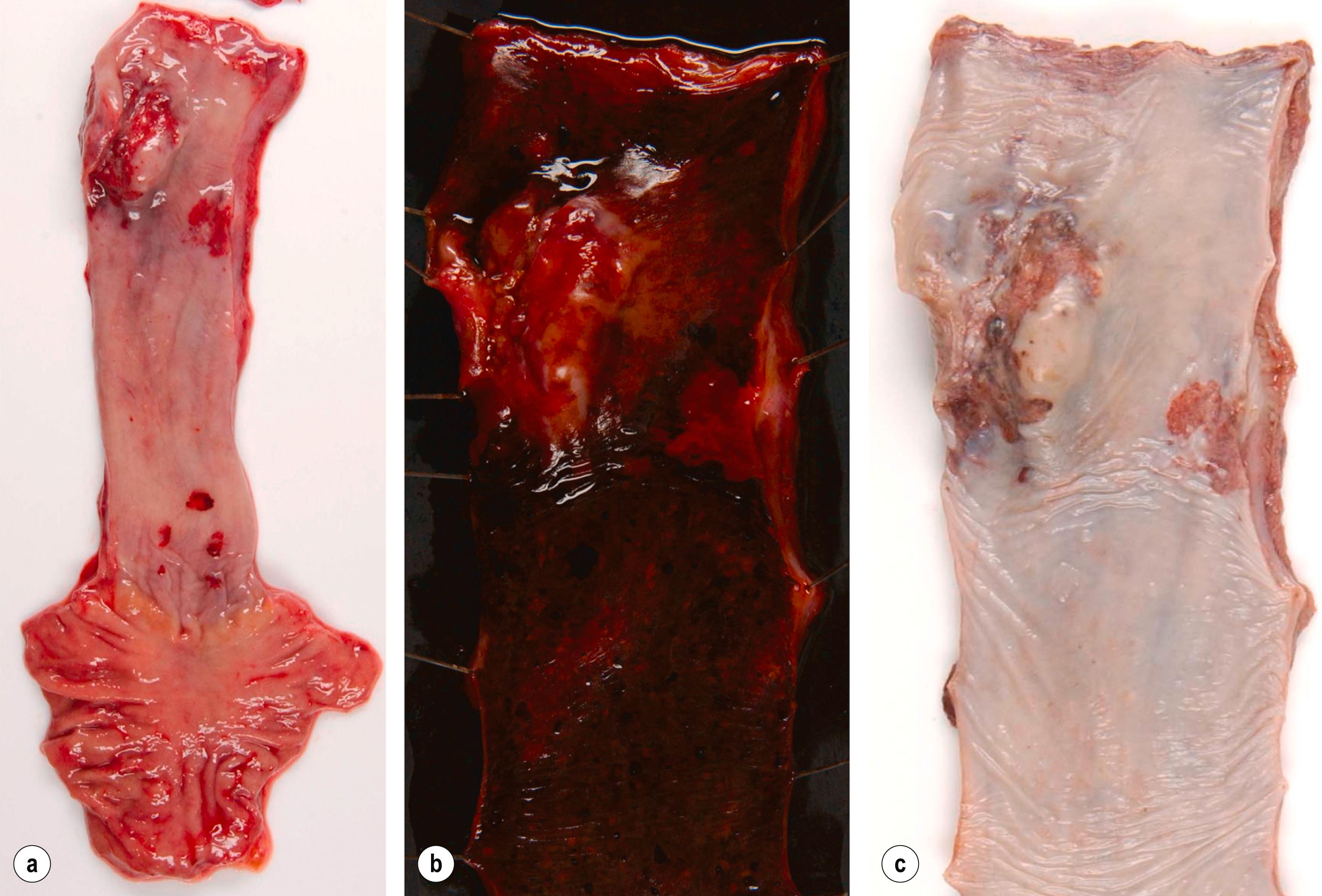 Fig. 1.3, Oesophageal squamous cell carcinoma located in the middle oesophagus. (a) Fresh oesophagectomy specimen with a polypoid exophytic tumour growth and a smaller flat (red-coloured) mucosal abnormality. (b) Lack of (dark) iodine staining in the abnormal areas. (c) Same specimen after fixation.