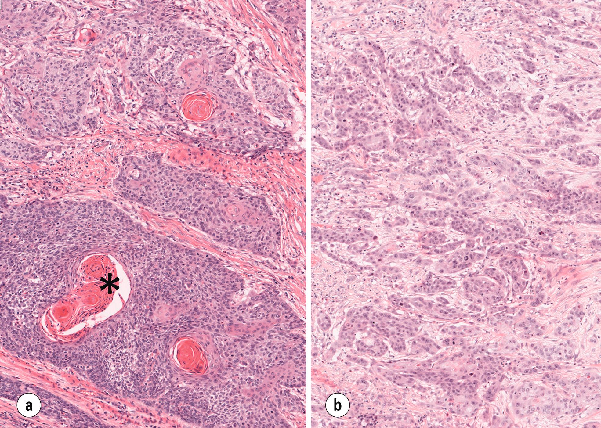 Fig. 1.4, Histological images of squamous cell carcinoma. (a) Moderate to well-differentiated squamous cell carcinoma showing evidence of keratinisation (∗ indicates area with keratinisation). (b) Poorly differentiated squamous cell carcinoma with small islands and strands of tumour cells within desmoplastic stroma without evidence of keratinisation.