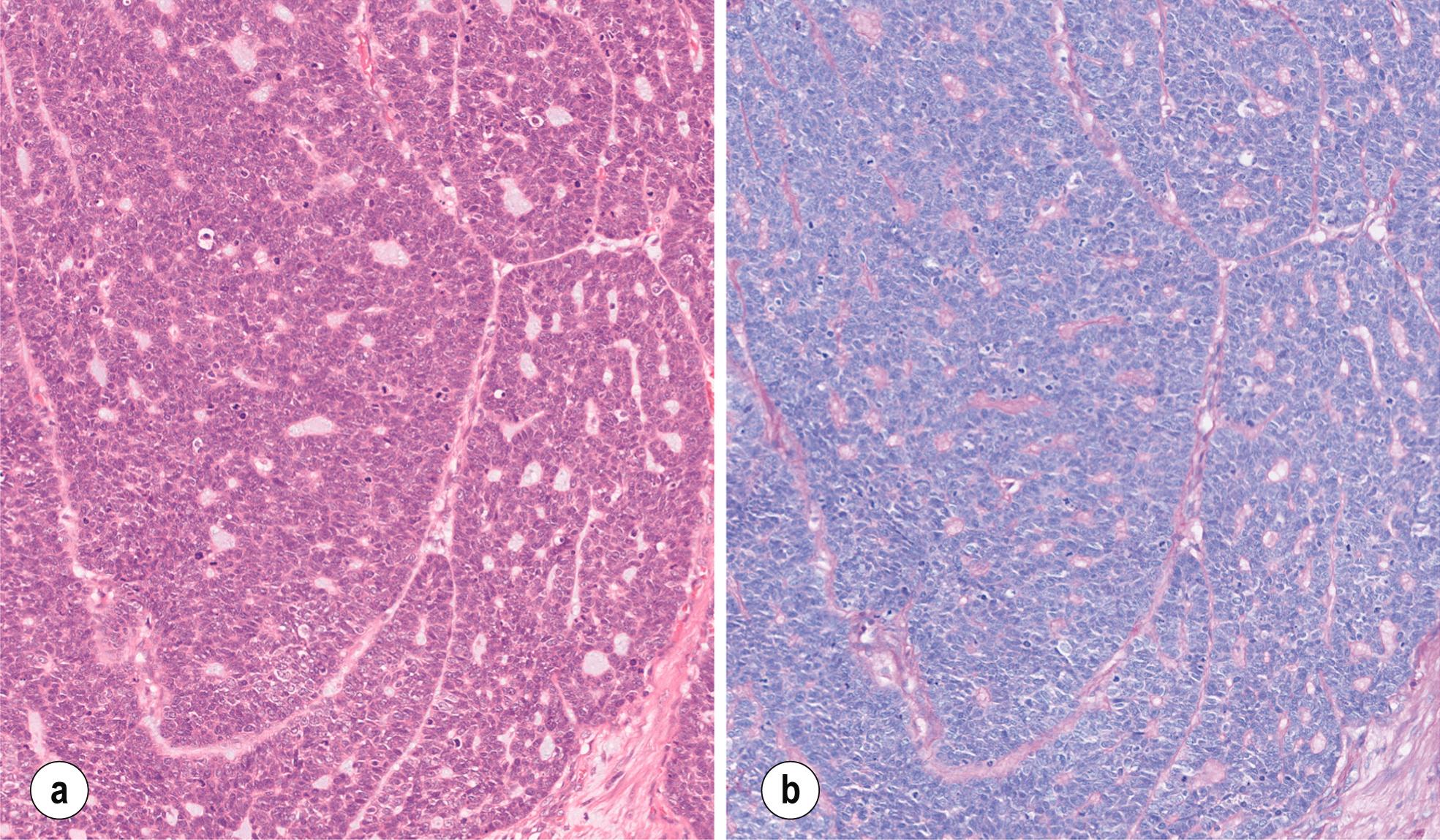 Fig. 1.5, Histology of basaloid squamous cell carcinoma. (a) Haematoxylin/eosin-stained section showing a tumour with a solid growth pattern and small gland-like structures. (b) PAS stained section of the same tumour showing light pink coloured material in the gland-like lumen.