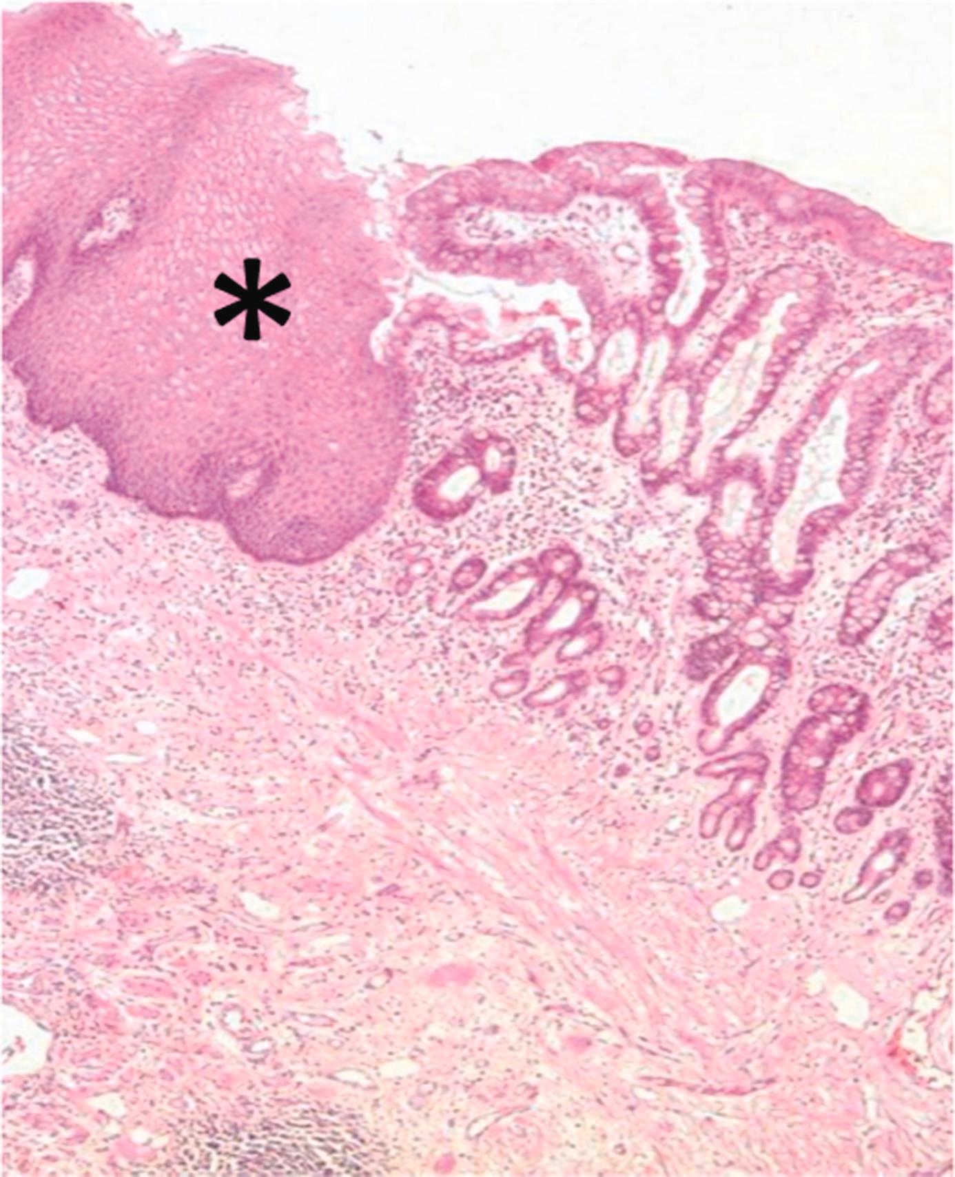 Fig. 1.6, Histology of Barrett’s oesophagus. Haematoxylin/eosin-stained tissue section showing normal squamous epithelium on the left (∗) and directly adjacent metaplastic intestinal-type mucosa with goblet cells as can be seen in Barrett’s oesophagus. No evidence of dysplasia.