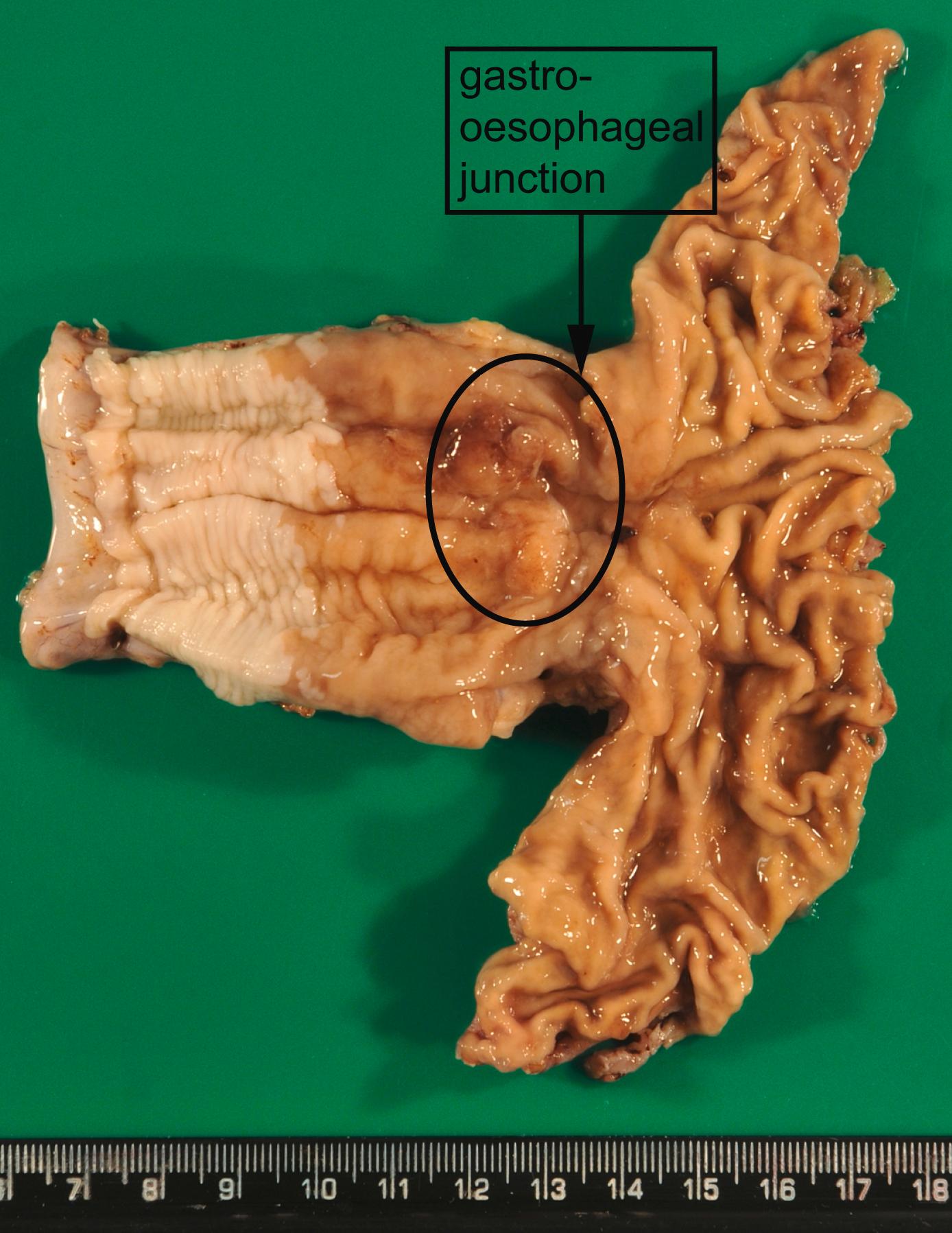 Fig. 1.7, Macroscopy of a distal oesophagectomy with Barrett’s oesophagus and adenocarcinoma. An irregular, partly ulcerated tumour (black circle) is located at the gastro-oesophageal junction. Between the proximal edge of the tumour and the squamous lined oesophagus is metaplastic columnar epithelium. The squamocolumnar junction (border between the pale-appearing squamous epithelium and brownish-appearing metaplastic epithelium) is located at least 2.5 cm proximal to the gastro-oesophageal junction.