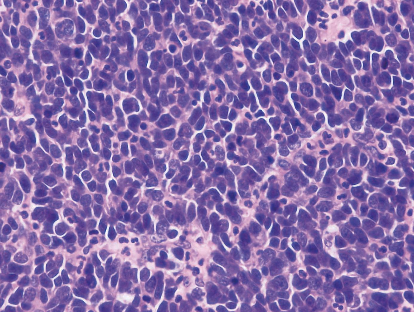 Fig. 1.8, Microscopic image of a neuroendocrine carcinoma.