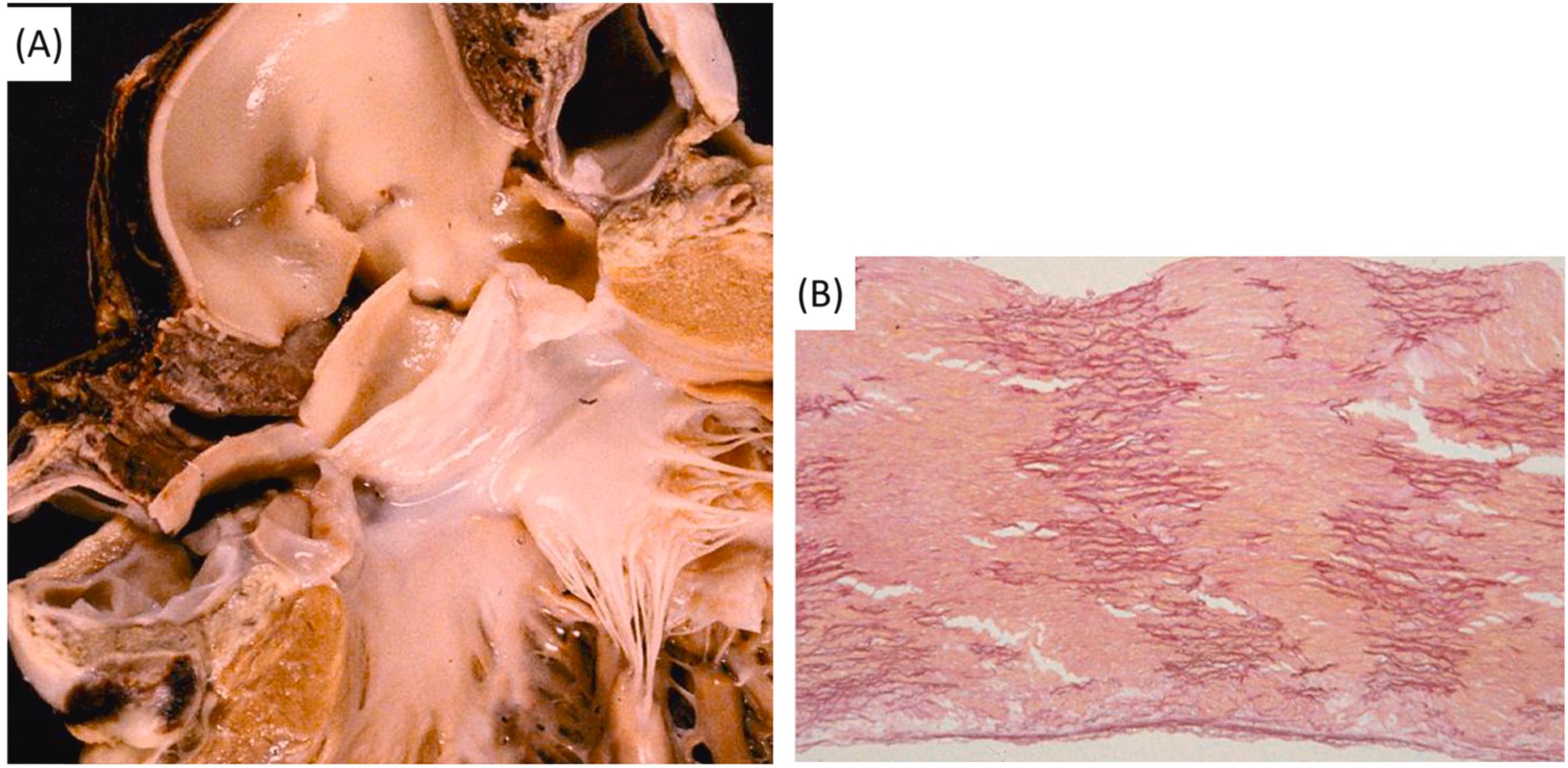 Figure 11.11, Bicuspid aortic valve with aortic dissection and mechanical sudden cardiac death in a 24-year-old man. (A) Spontaneous intimal laceration and dissection of the ascending aorta in a heart with a normally functioning bicuspid aortic valve. (B) Massive disappearance of elastic lamellae of the aortic tunica media (Weigert-van Gieson).