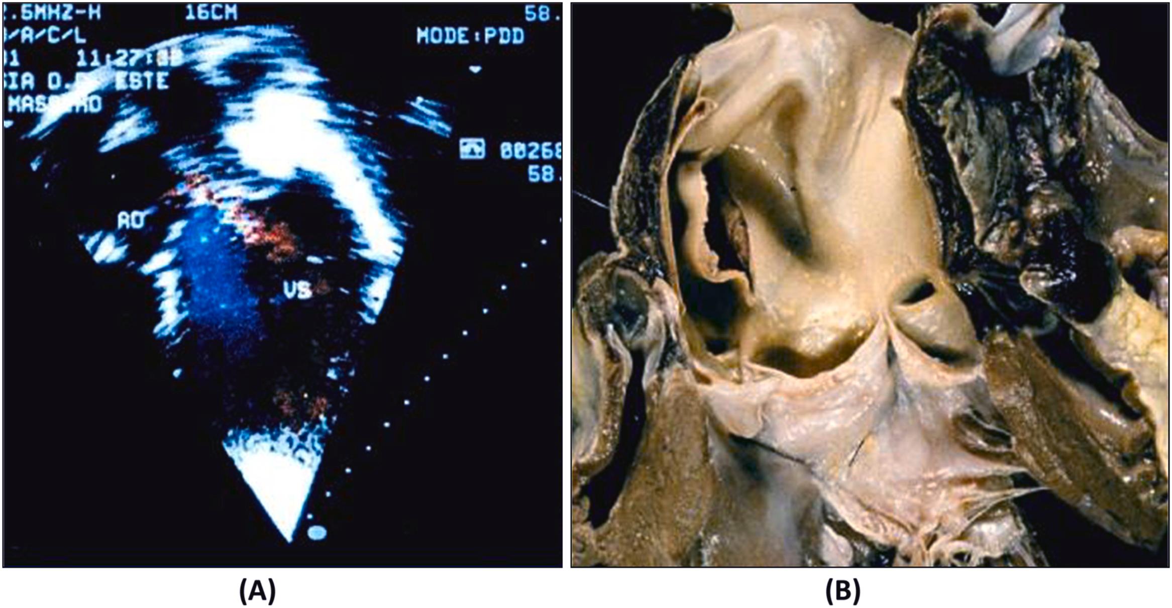 Figure 11.12, Aortic dissection and sudden death in a 31-year-old man with bicuspid aortic valve. (A) Aortic valve incompetence by echo at last follow-up. (B) Ten months later intimal tear and dissection of the ascending aorta. Diameter of aorta 38 mm.