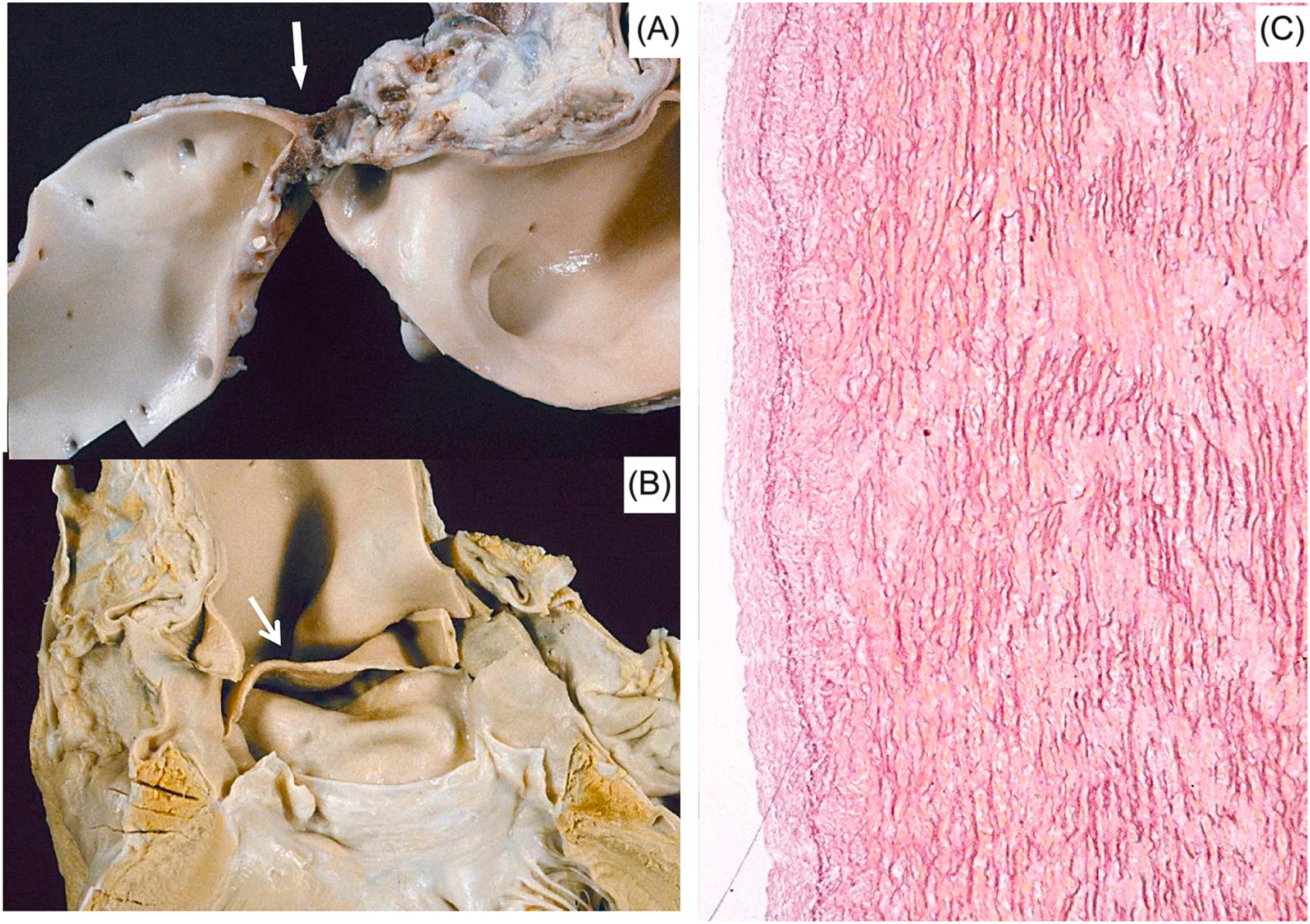 Figure 11.13, Bicuspid aortic valve and isthmic coarctation with aortic dissection and mechanical sudden cardiac death in a 17-year-old boy. (A) Coarctation of the aortic isthmus ( arrow ). (B) Wide intimal tear ( arrow ) in the ascending aorta, a couple of centimeters above a bicuspid aortic valve. (C) Histology shows disruption of the elastic lamellae in the tunica media (Weigert-van Gieson).