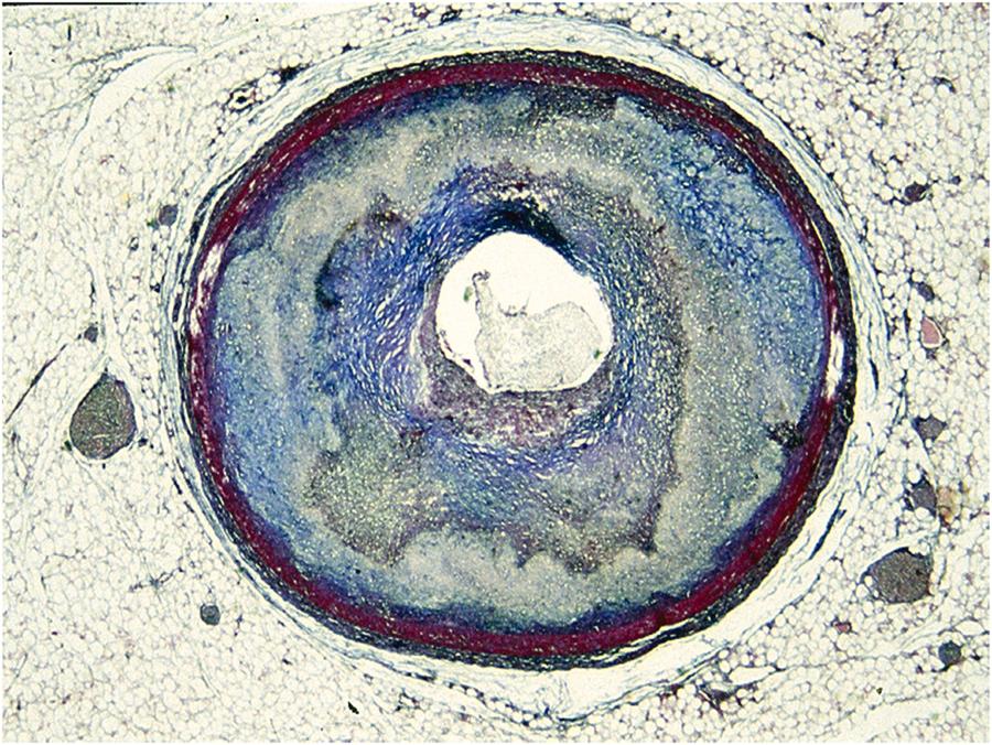 Figure 11.14, Sudden coronary death. Critical stenosis (>75%) of the descending coronary artery (“the coronary artery of sudden death”) by a concentric atherosclerotic plaque (Heidenhain trichrome).