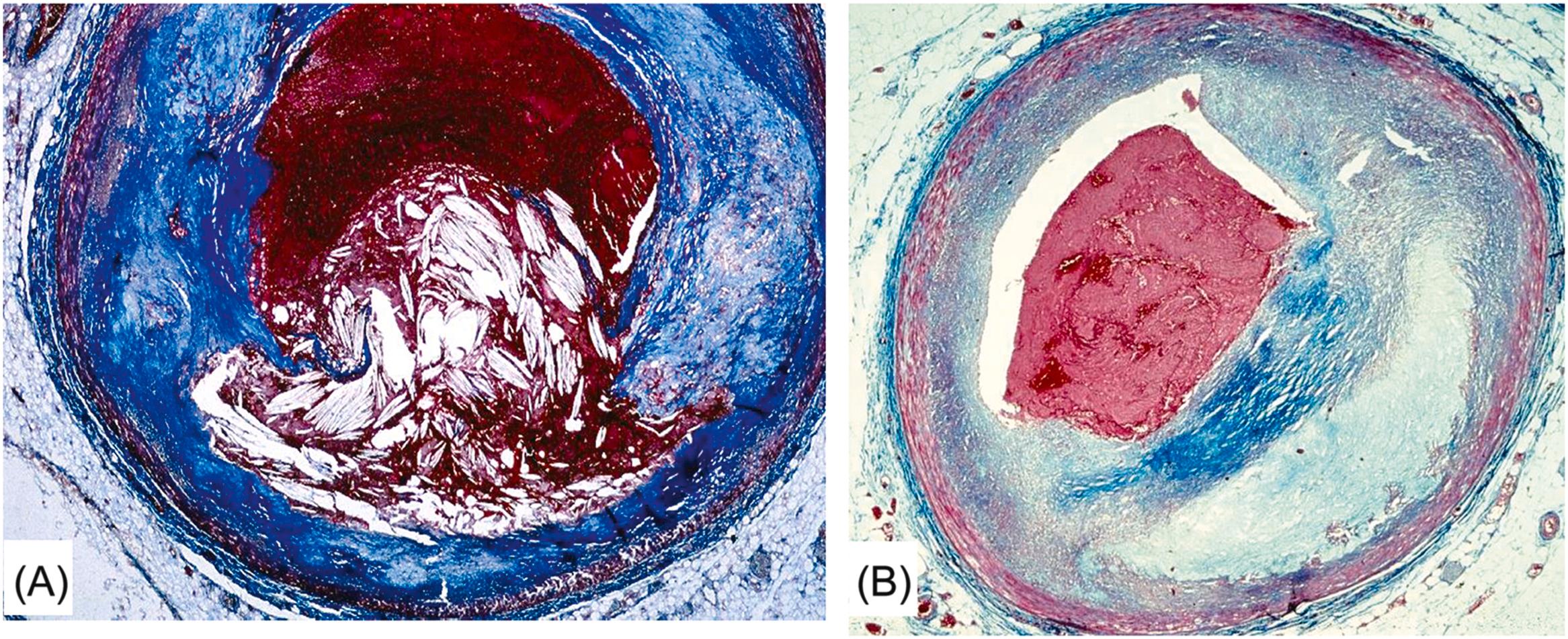 Figure 11.15, Arrhythmic sudden cardiac death caused by occlusive thrombosis of the left anterior descending coronary artery. (A) The acute occlusive thrombosis is related to a ruptured atherosclerotic plaque with a thin fibrous cap. (B) Acute occlusive thrombosis upon an atherosclerotic plaque with a thick fibrous cap, caused by endothelial erosion (Heidenhain trichrome).