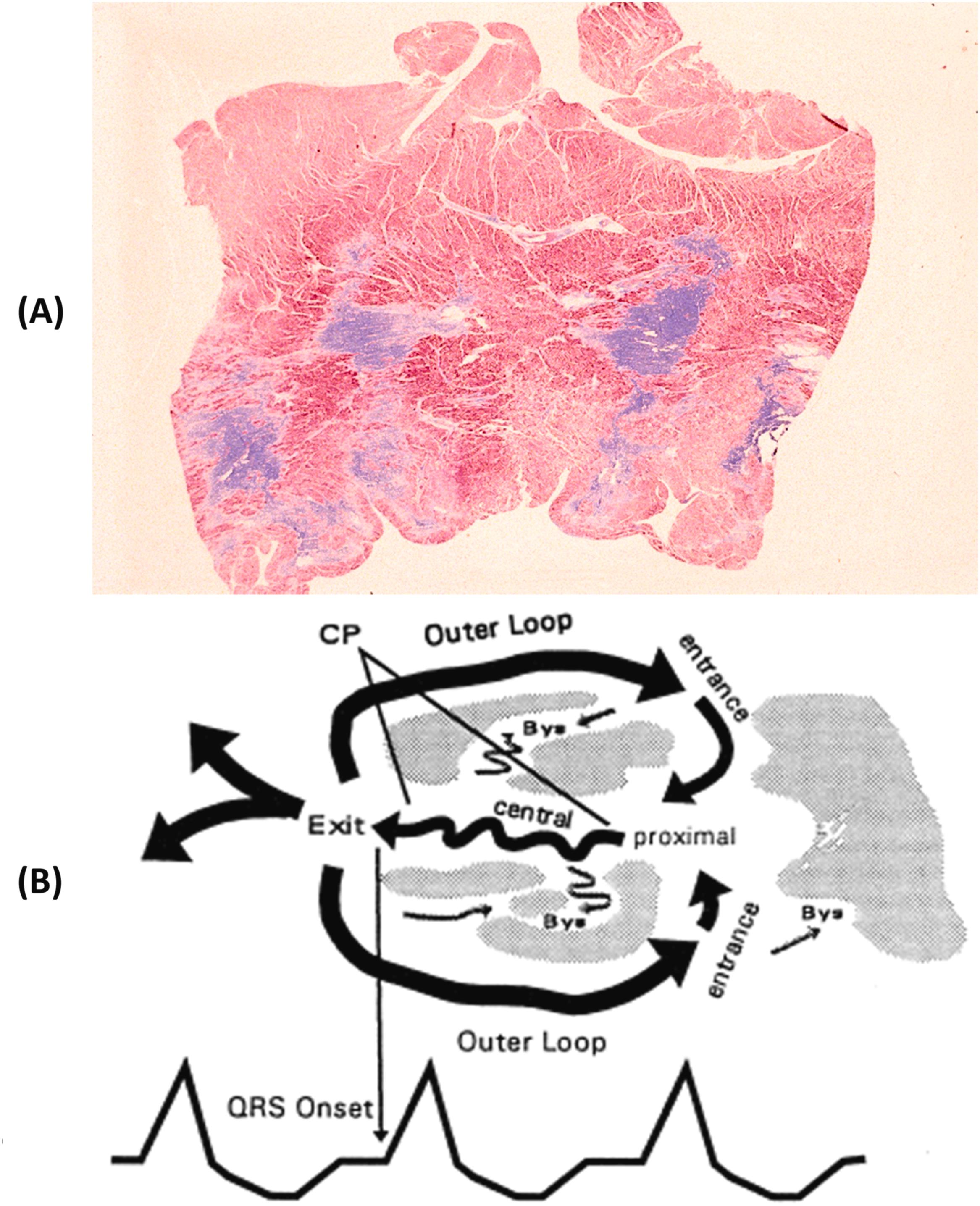 Figure 11.16, (A) Arrhythmic sudden cardiac death in a healed myocardial infarction. “Archipelago-like” spots of replacement-type fibrosis are scattered in the anteroseptal wall of the left ventricle accounting for a “zig zag” intraventricular impulse propagation (Heidenhain trichrome). (B) Circuit that contains two loops and a common pathway (CP) through which conduction is slowed, creating a “figure-eight” configuration. The common pathway is a relatively small mass of tissue in the chronic infarct, depolarization of which generates low amplitude signals that are not detectable in the standard body surface ECG. The common pathway has an exit and central and proximal regions. The QRS complex is inscribed after the excitation wavefront leaves the common pathway at the exit ( arrow to the QRS onset at bottom) and begins propagating around the border of the scar through two outer loops. The excitation wavefronts then enter the infarct region through entrances to reach the proximal portion of the common pathway. Several regions that are in the chronic infarct but do not participate in the circuit are labeled as bystanders (Bys).