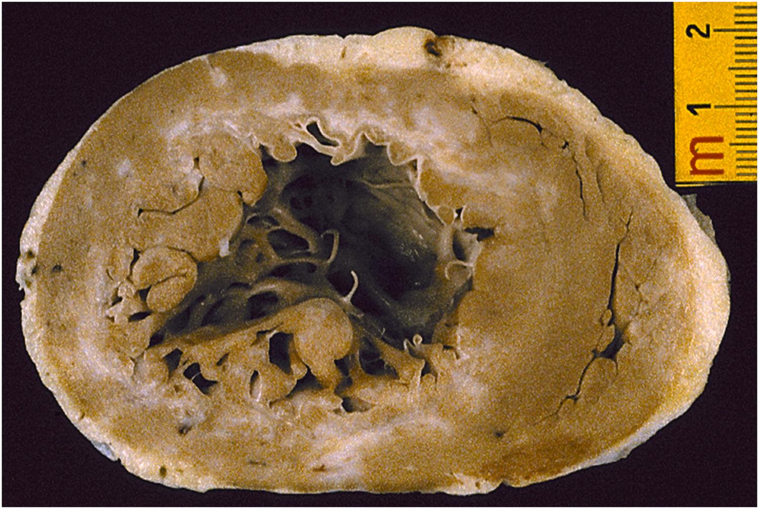 Figure 11.17, Sudden death in a 70-year-old male with chronic ischemic heart disease and severe impairment of left ventricle ejection fraction (<35%). Short-axis section: note circumferential subendocardial postinfarct sclerosis.