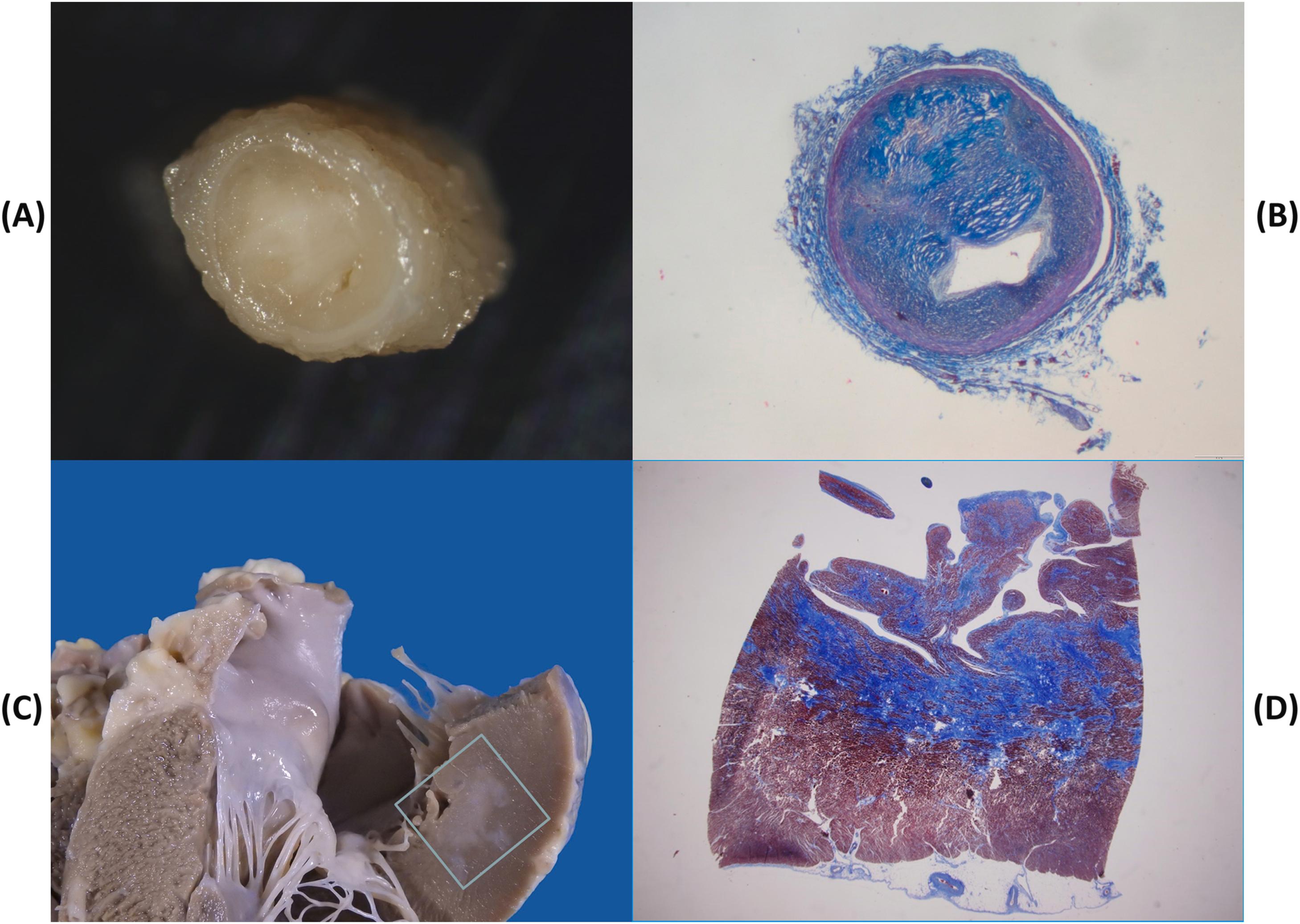 Figure 11.18, Sudden coronary death in a 52-year-old man with previous myocardial infarction and preserved ejection fraction (50%). (A, B) Critical stenosis by eccentric plaque of the left circumflex coronary artery. (C, D) Subendocardial scar in the lateral wall of the left ventricle (Heidenhain stain).