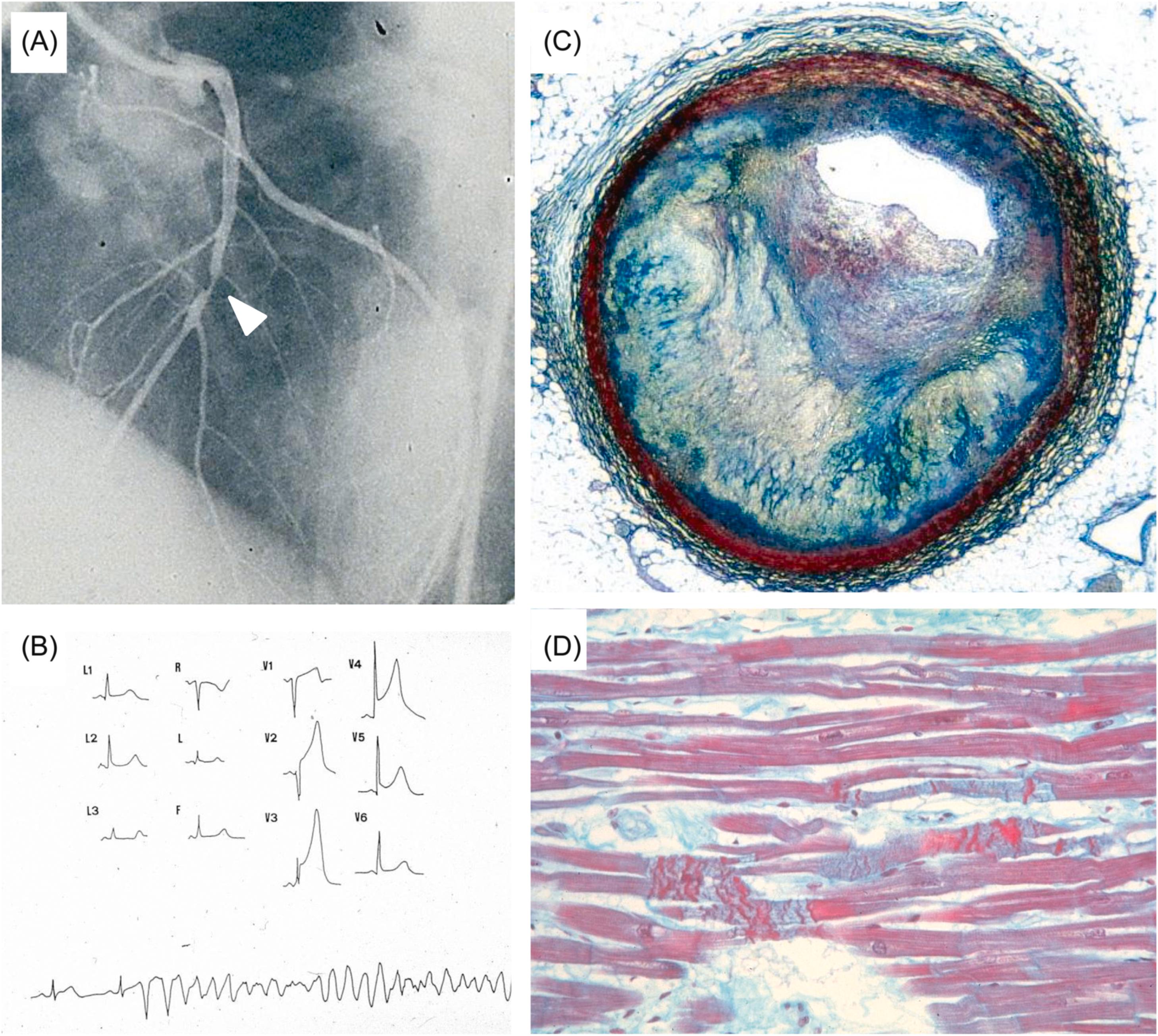 Figure 11.19, Arrhythmic sudden cardiac death in a 45-year-old man with Prinzmetal’s variant angina. (A) Selective left coronary angiography showing a single eccentric obstructive plaque in the mid segment of the left anterior descending coronary artery ( arrow head ). (B) Electrocardiographic tracing showing marked ST segment elevation followed by ventricular fibrillation. (C) Histology demonstrating atherosclerotic plaque with severe eccentric stenosis and intimal proliferation of the left anterior descending coronary artery. (D) Early signs of ischemic injury with contraction band necrosis, in keeping with transient ischemia and reperfusion injury (C and D, Heidenhain trichrome).