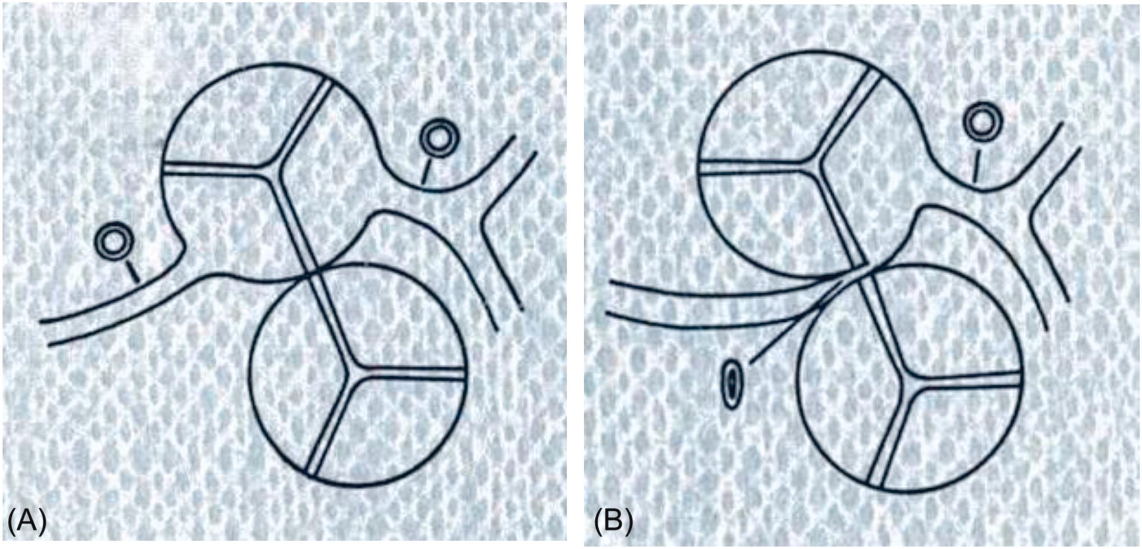 Figure 11.20, Diagrams illustrating normal origin of coronary arteries from right and left aortic sinuses of Valsalva (A) and anomalous origin of the right coronary artery from the wrong left aortic sinus (B). In the latter condition, note the proximal course between aorta and pulmonary trunk of the anomalous coronary artery with an acute angle take-off and a slit-like lumen.