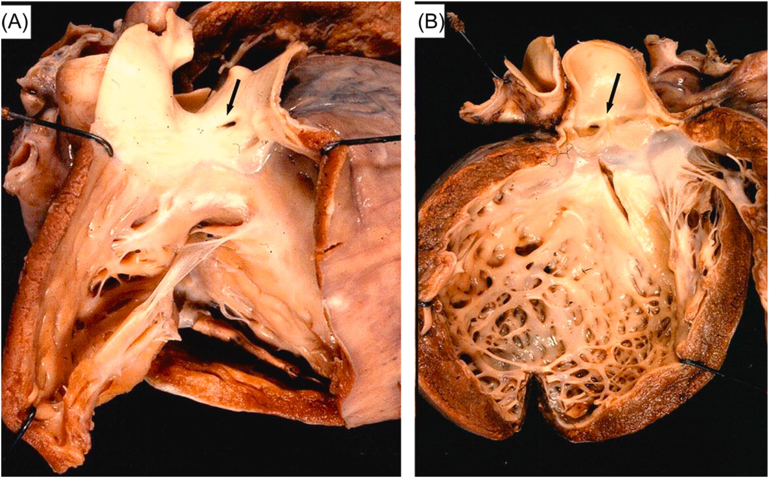 Figure 11.21, Arrhythmic sudden cardiac death caused by the anomalous origin of the left coronary artery from the pulmonary trunk in a 4-month-old infant. (A) View of the right ventricle and the pulmonary artery; note a coronary ostium located in the left posterior facing pulmonary sinus of Valsalva ( arrow ). (B) View of the left ventricle and aorta: only the right coronary artery ostium is regularly located in the right anterior facing aortic sinus of Valsalva ( arrow ). A remarkable left ventricular dilatation resulted from previous myocardial infarction, with fibroelastic endocardial thickening.