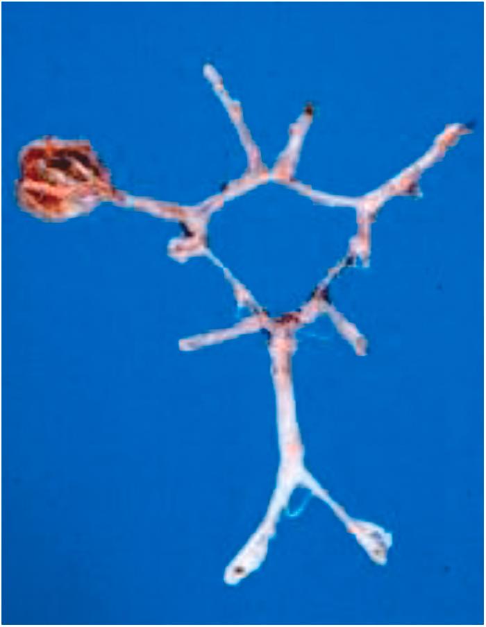 Figure 11.3, Cerebral sudden death due to subarachnoid hemorrhage. Note the berry aneurysm of the right middle cerebral artery of the Willis circle.