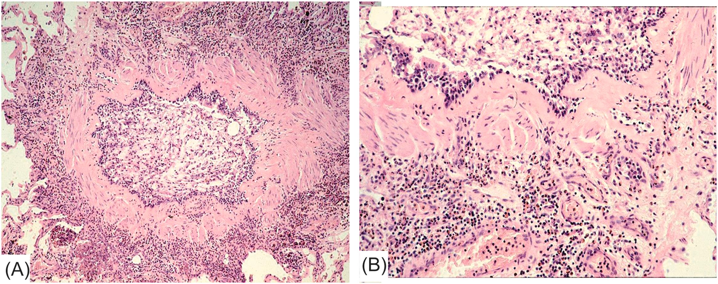 Figure 11.4, Respiratory sudden death due to allergic bronchial asthma. (A) Histology showing airway obstruction due to plugs in the bronchial lumen. (B) Note the smooth muscle layer hypertrophy, the thickening of the bronchial basal membrane, and inflammatory infiltrate rich in eosinophils in the bronchial-peribronchial wall (Hematoxylin–Eosin stain).