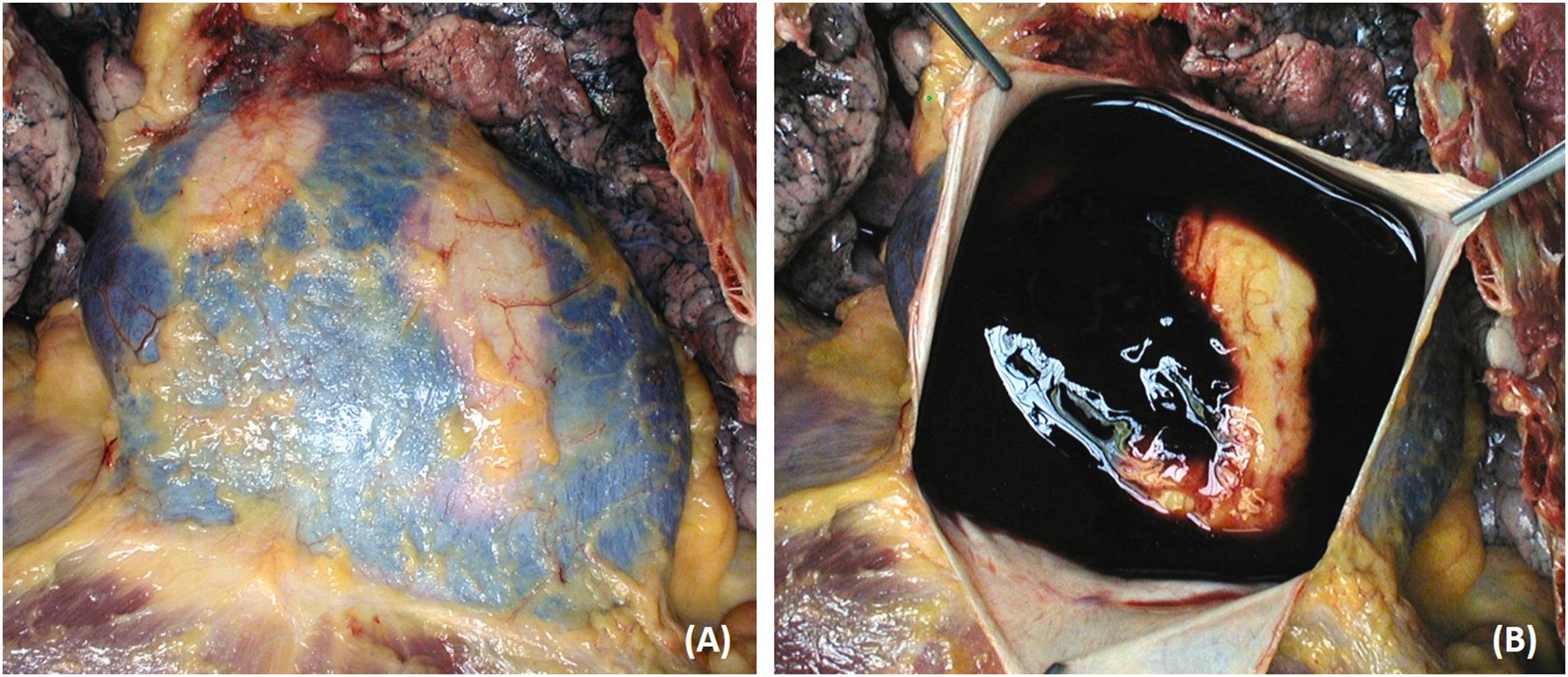 Figure 11.5, Mechanical cardiovascular sudden death. Cardiac tamponade due to hemopericardium impairs diastolic ventricular filling and cardiac output. (A) Enlarge cardiac siluette. (B) The pericardial cavity is full of blood with cardiac tamponade.