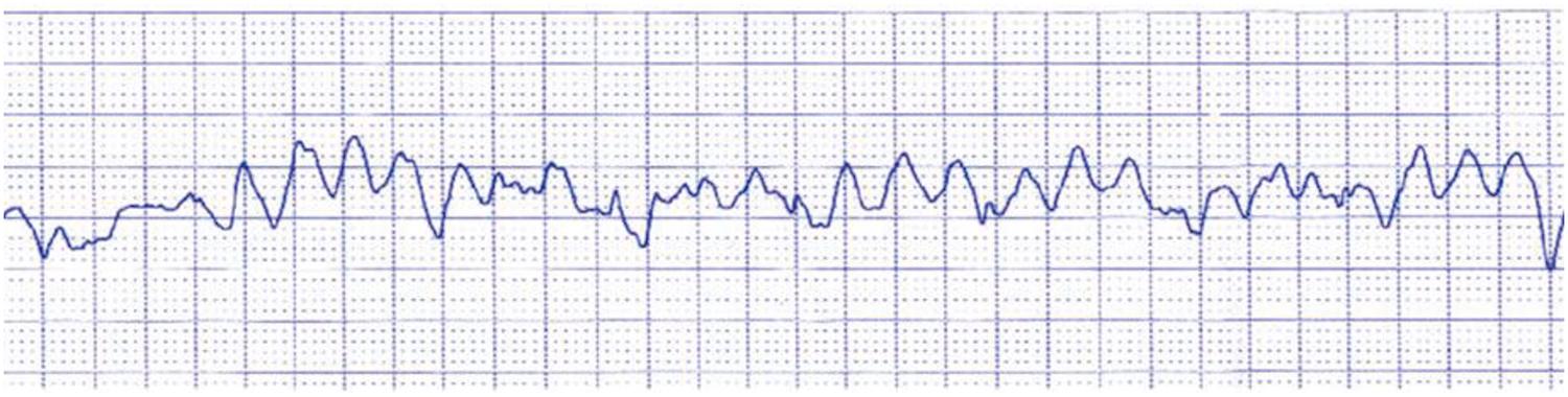 Figure 11.7, Arrhythmic cardiac arrest: electrocardiographic tracing of ventricular tachycardia evolving into ventricular fibrillation.