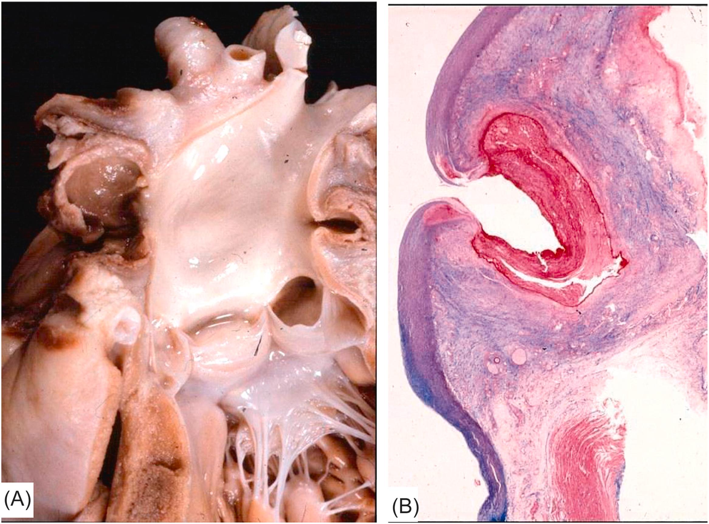 Figure 11.8, Mycotic aneurysm of the ascending aorta with rupture and mechanical sudden cardiac death by hemopericardium and cardiac tamponade in a 3-year-old child. (A) Saccular aneurysm of the ascending aorta, 1 cm above the sinotubular junction, leading to transmural rupture and cardiac tamponade. (B) Histology showing through-and-through aortic wall laceration with pseudoaneurysm (Heidenhain trichrome).