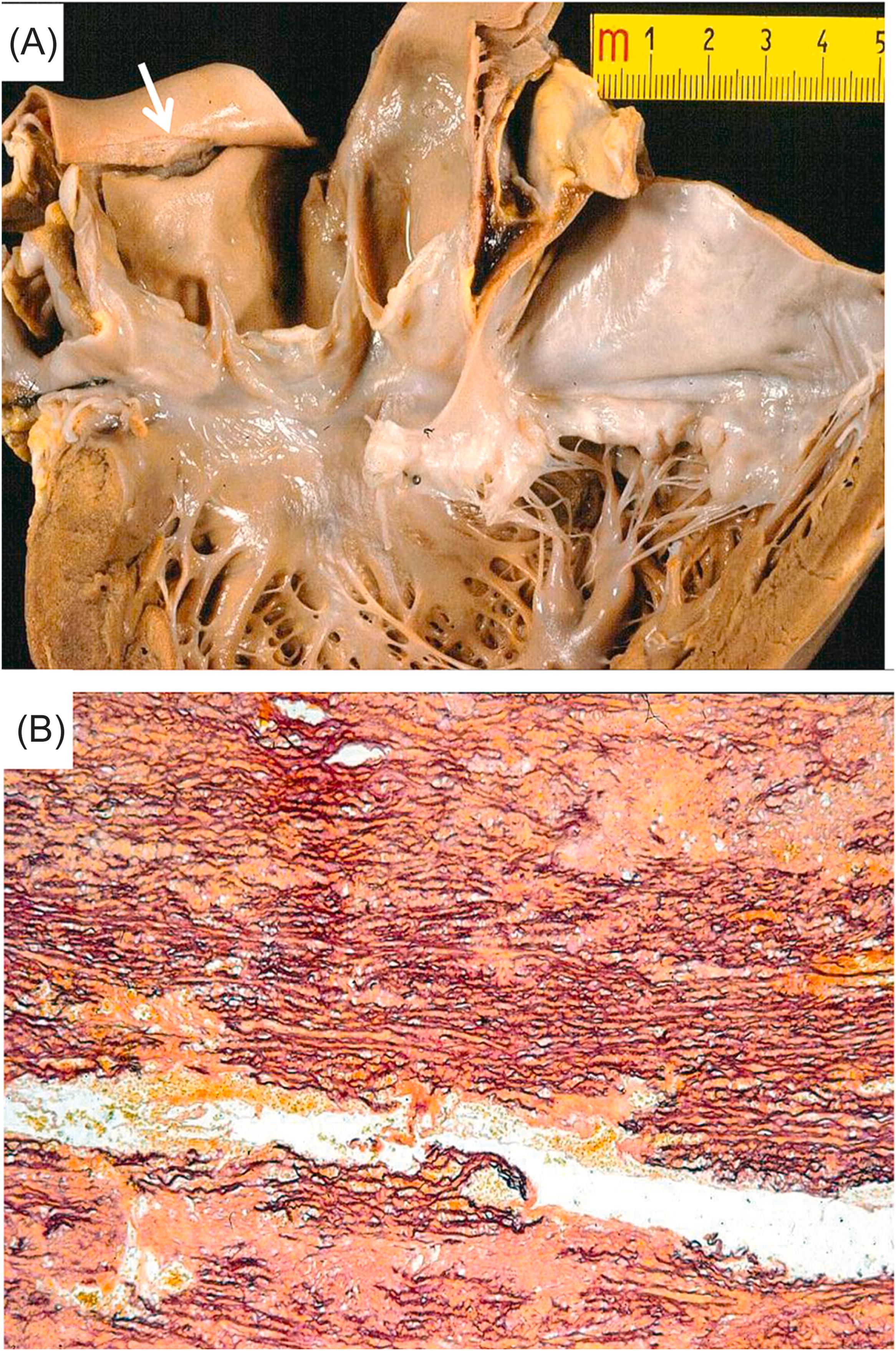 Figure 11.9, Marfan syndrome with aortic dissection, and mechanical sudden cardiac death in a 31-year-old man. (A) View of the left side of the heart and the ascending aorta with annuloaortic ectasia and intimal tear ( arrow ) located 2 cm above the sinotubular junction. Note mitral valve prolapse. (B) Histology of the aortic wall showing dissection of the tunica media, affected by severe elastic disruption (Weigert–van Gieson).