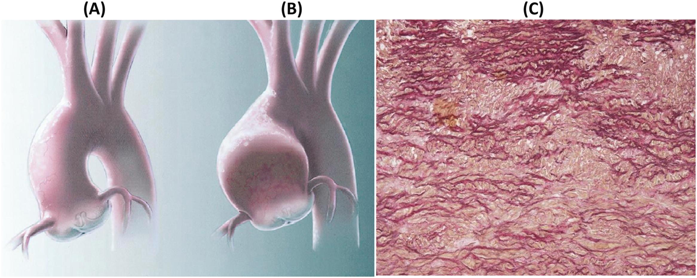 Figure 11.10, Bicuspid aortic valve aortopathy. (A) Normal ascending aorta. (B) Dilated ascending aorta. (C) Fragmentation and loss of lamellar units of the tunica media (Weigert–van Gieson).