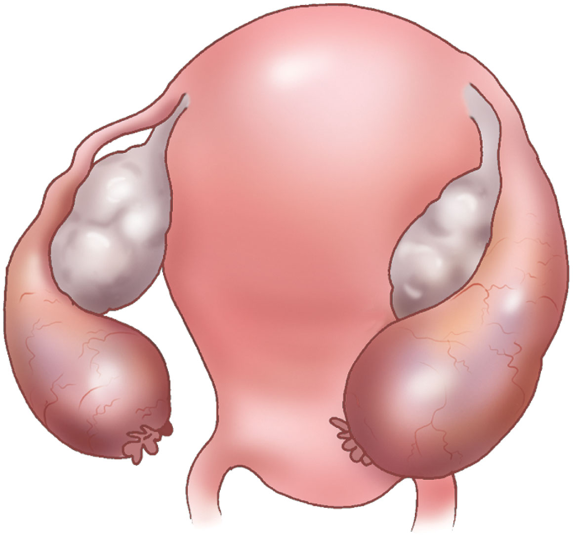 Fig. 45.2, Salpingitis is an inflammation of the fallopian tubes that causes nodular dilation. This infection may be unilateral or bilateral.