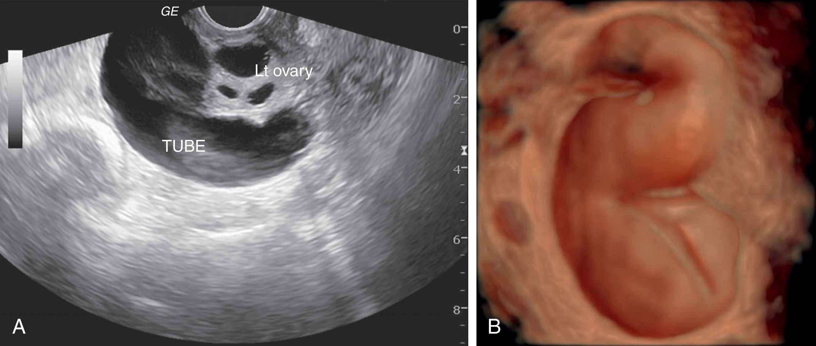 Fig. 45.3, (A) Hydrosalpinx. Patient presented with abdominal pain, status post-hysterectomy, and right oophorectomy 5 years prior. A serpiginous, mostly anechoic structure abuts the left ovary. Fluid accumulates from tubal secretions. (B) Three-dimensional rendering of the hydrosalpinx demonstrates the dilation and curvature of the tube.