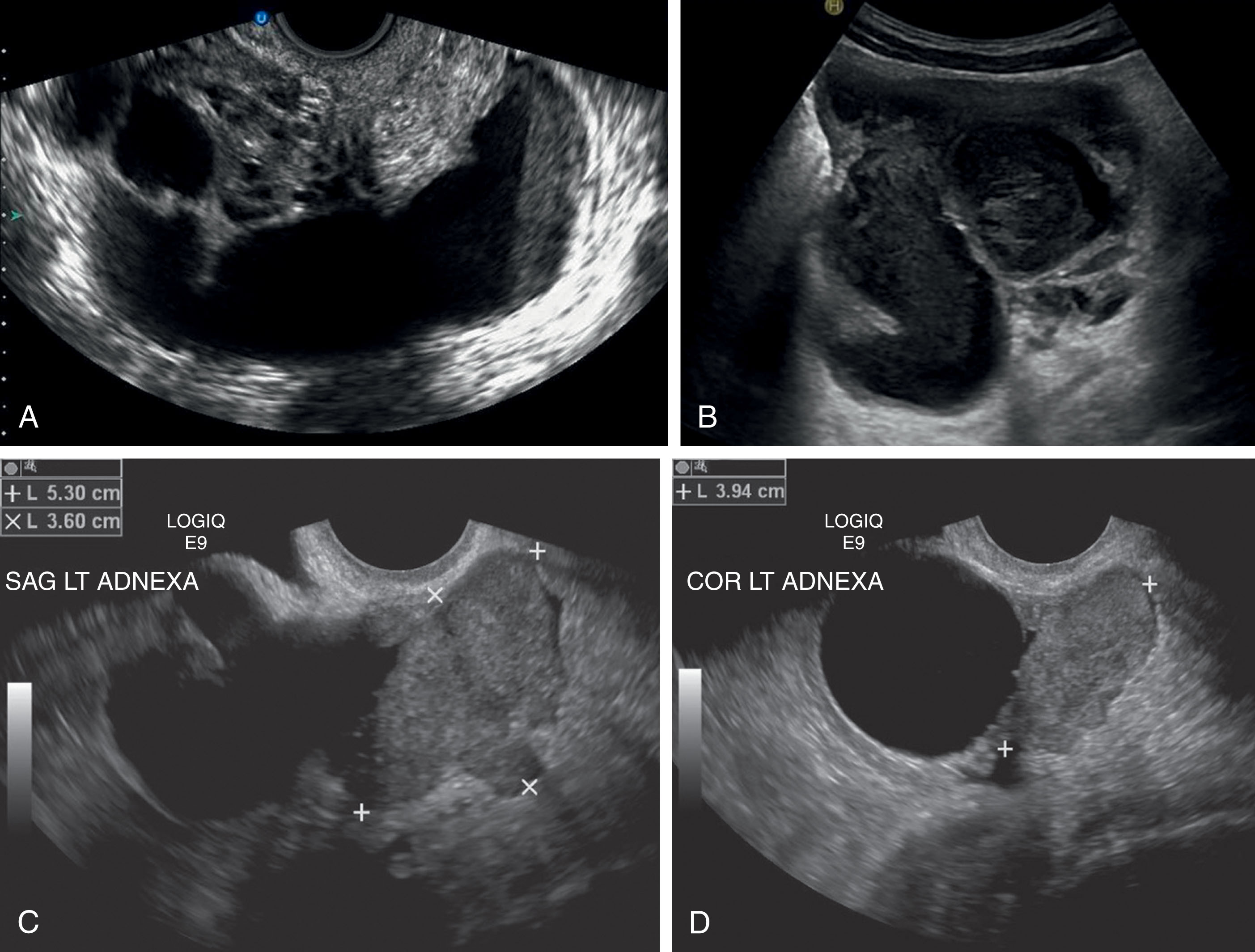 Fig. 45.4, (A) Pyosalpinx. In the presence of infection, the fallopian tube fills with pus, which is seen as low-level echoes and thick walls. (B) Acute salpingitis. The tube is enlarged and distended with pus appearing as complex echoes within. Note the thick walls. (C–D) Hydrosalpinx. This 81-year-old patient presented with left lower leg swelling. Computed tomography confirmed left common iliac vein thrombosis. Ultrasound demonstrated a left hydrosalpinx with adjacent mass, possibly within the fallopian tube. Surgical pathology confirmed a left hydrosalpinx with adjacent ovarian serous adenocarcinoma.