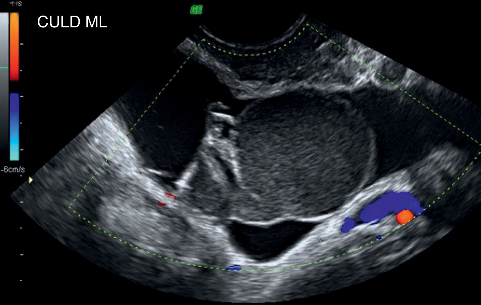 Fig. 45.5, Peritoneal pseudocyst with hemorrhagic mesothelial cyst.