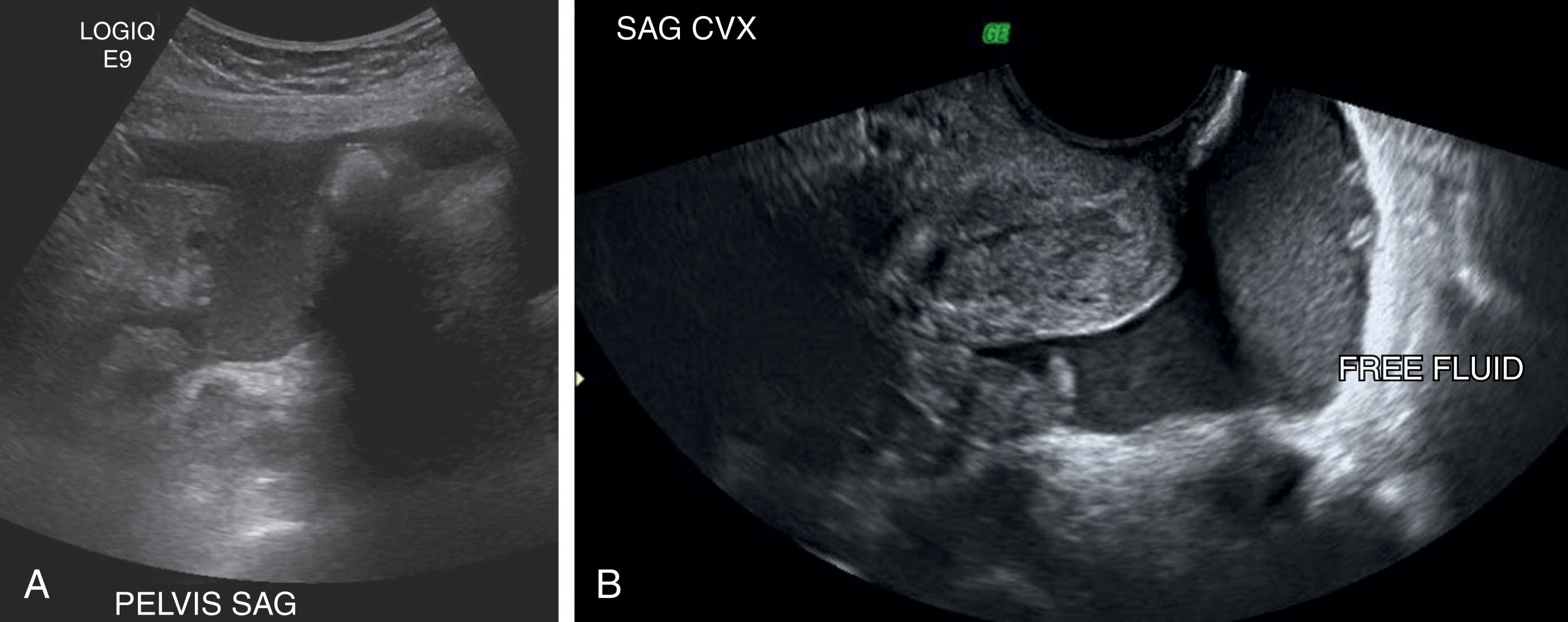 Fig. 45.6, (A) Pelvic fluid. Fluid in the pelvis from malignant ascites; this patient had primary carcinomatosis and endometrial adenocarcinoma. (B) Free fluid in cul-de-sac. This patient has free fluid in the cul-de-sac in addition to retained products of conception in the uterus. Low-level echoes within the fluid suggest blood or cellular debris.