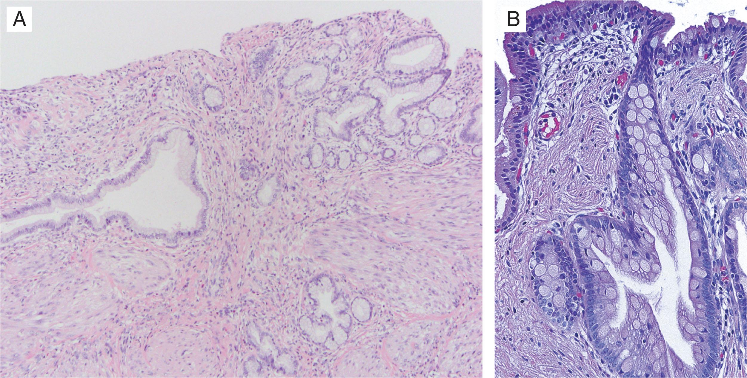 Pathology of the Gallbladder and Extrahepatic Bile Ducts - Clinical Tree