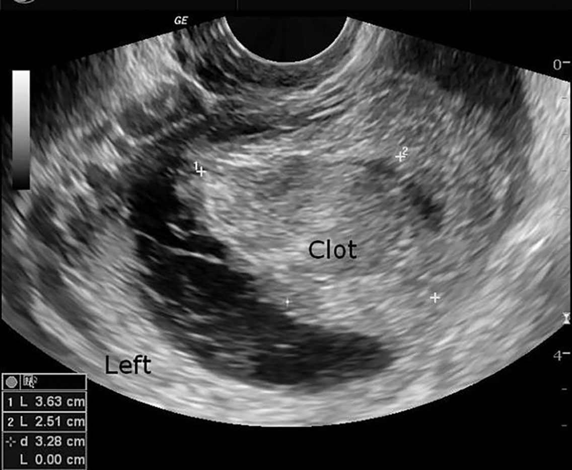 Fig. 44.11, Corpus luteum cysts result from failure of resorption or from excess bleeding into the corpus luteum