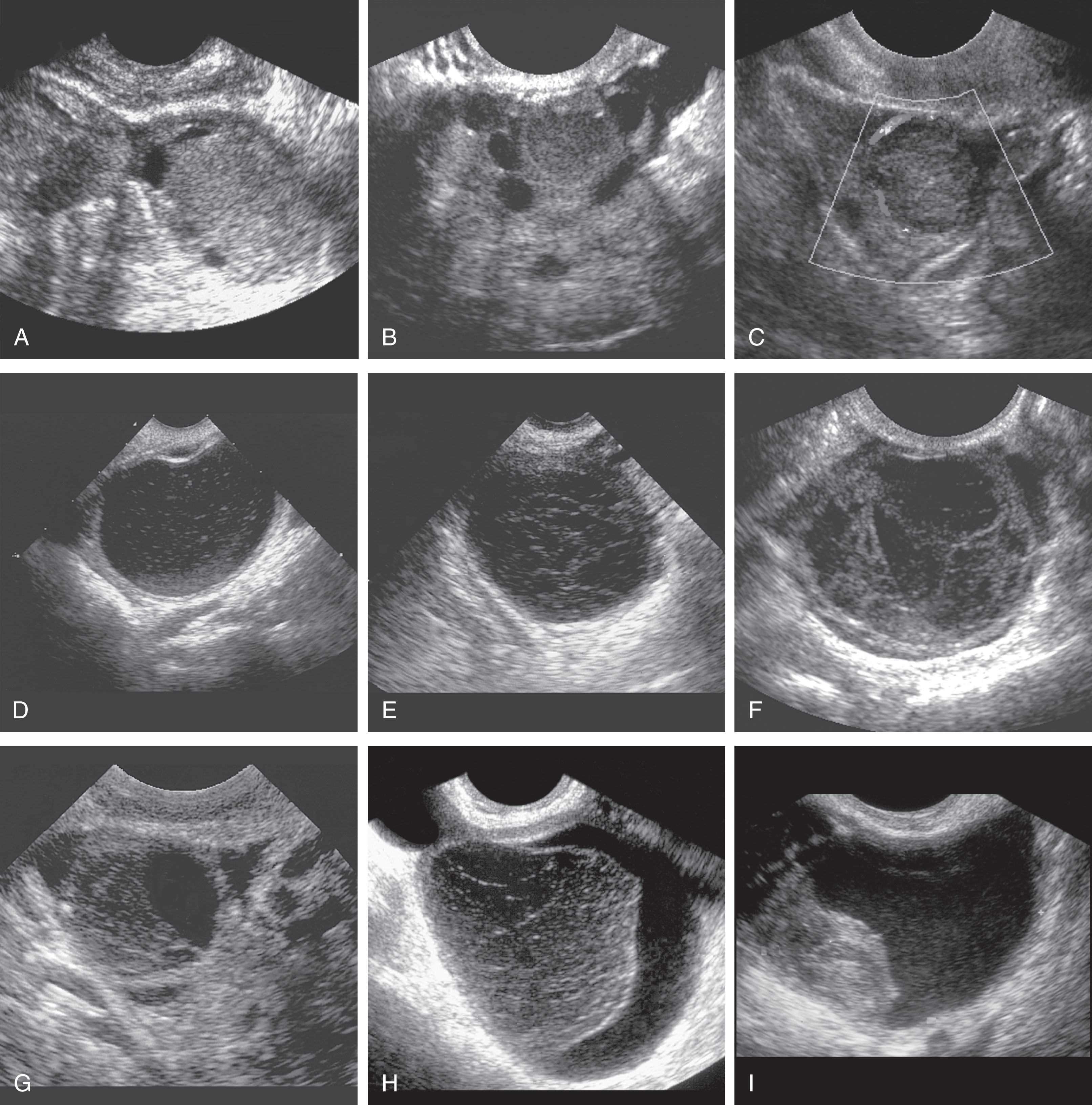 Fig. 44.12, Hemorrhagic cysts on transvaginal scans: spectrum of appearances