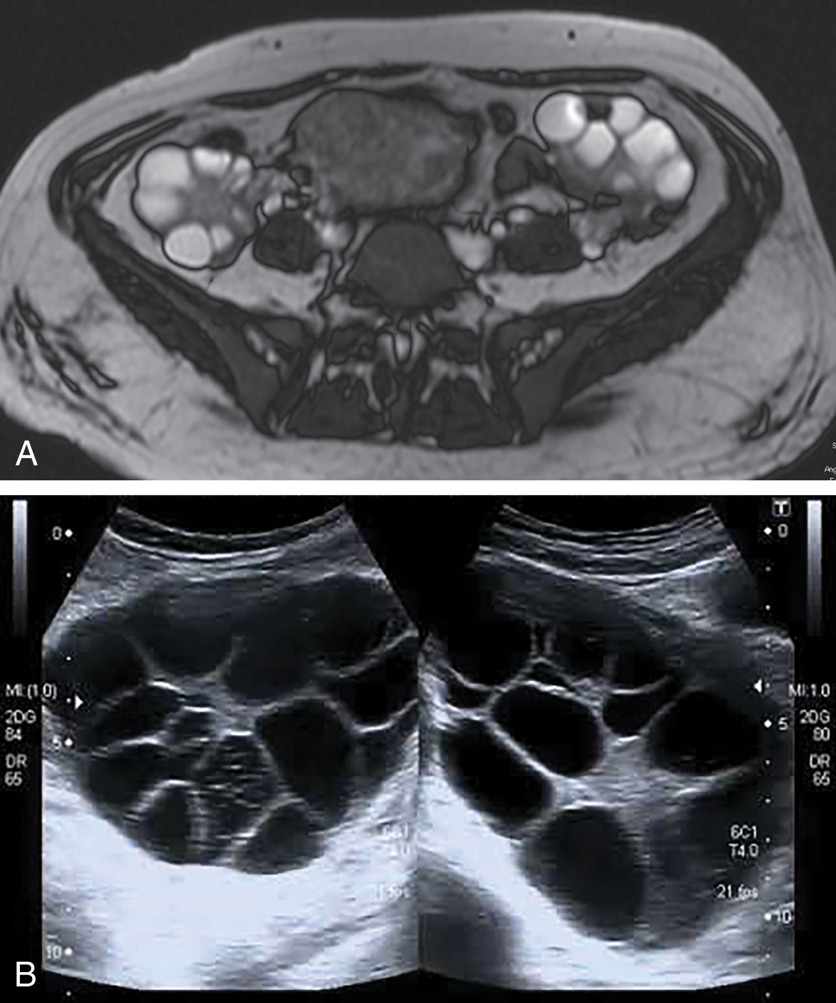 Fig. 44.13, Theca-lutein cysts are the largest of the functional cysts and appear as very large, bilateral, multiloculated cystic masses. They are associated with high levels of human chorionic gonadotropin. Magnetic resonance (A) and ultrasound (B) images of the multiloculated cysts.