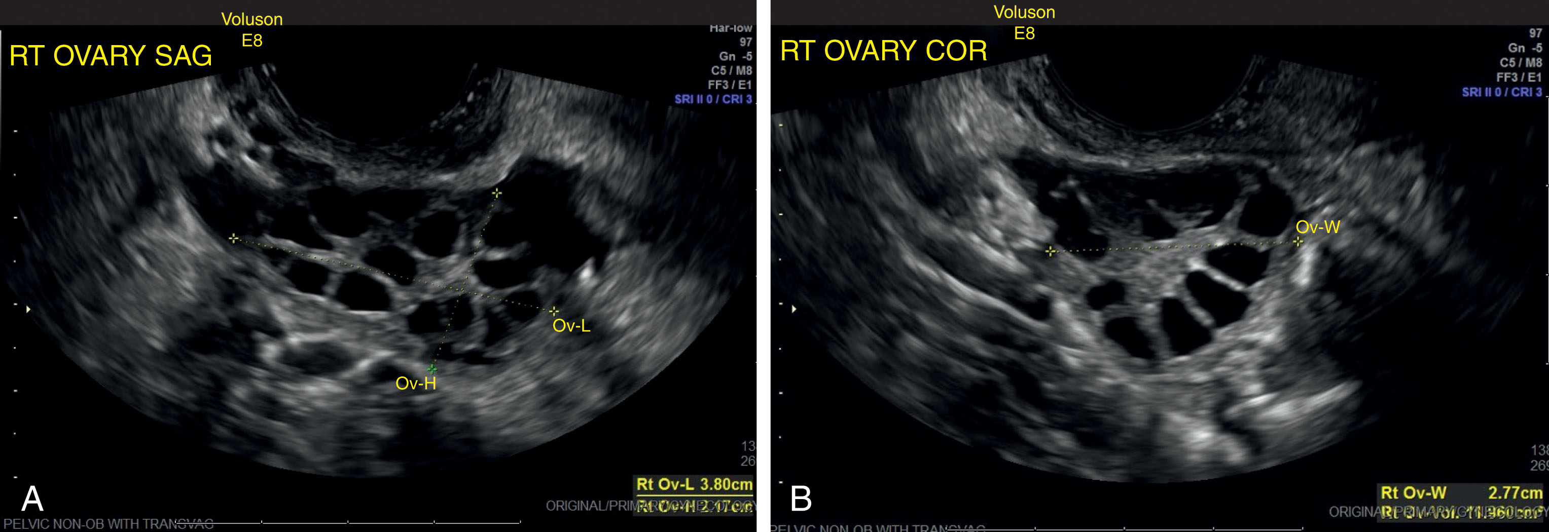 Fig. 44.15, Polycystic ovarian syndrome