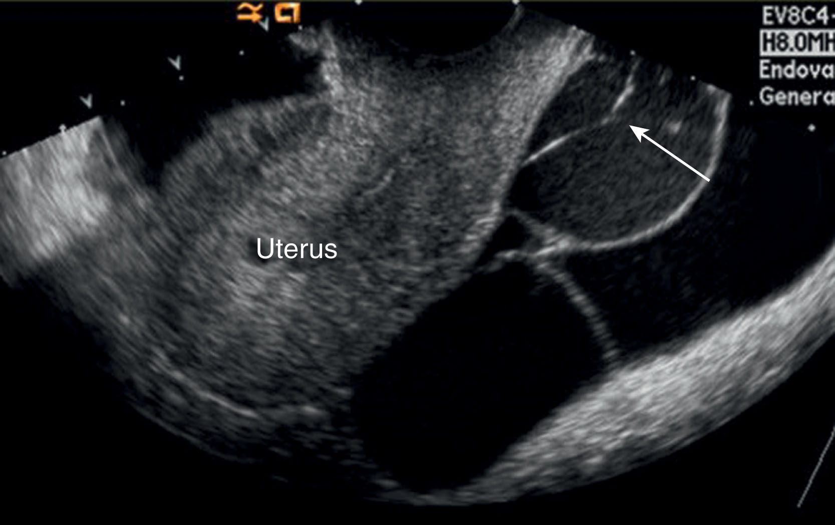 Fig. 44.16, Peritoneal inclusion cyst