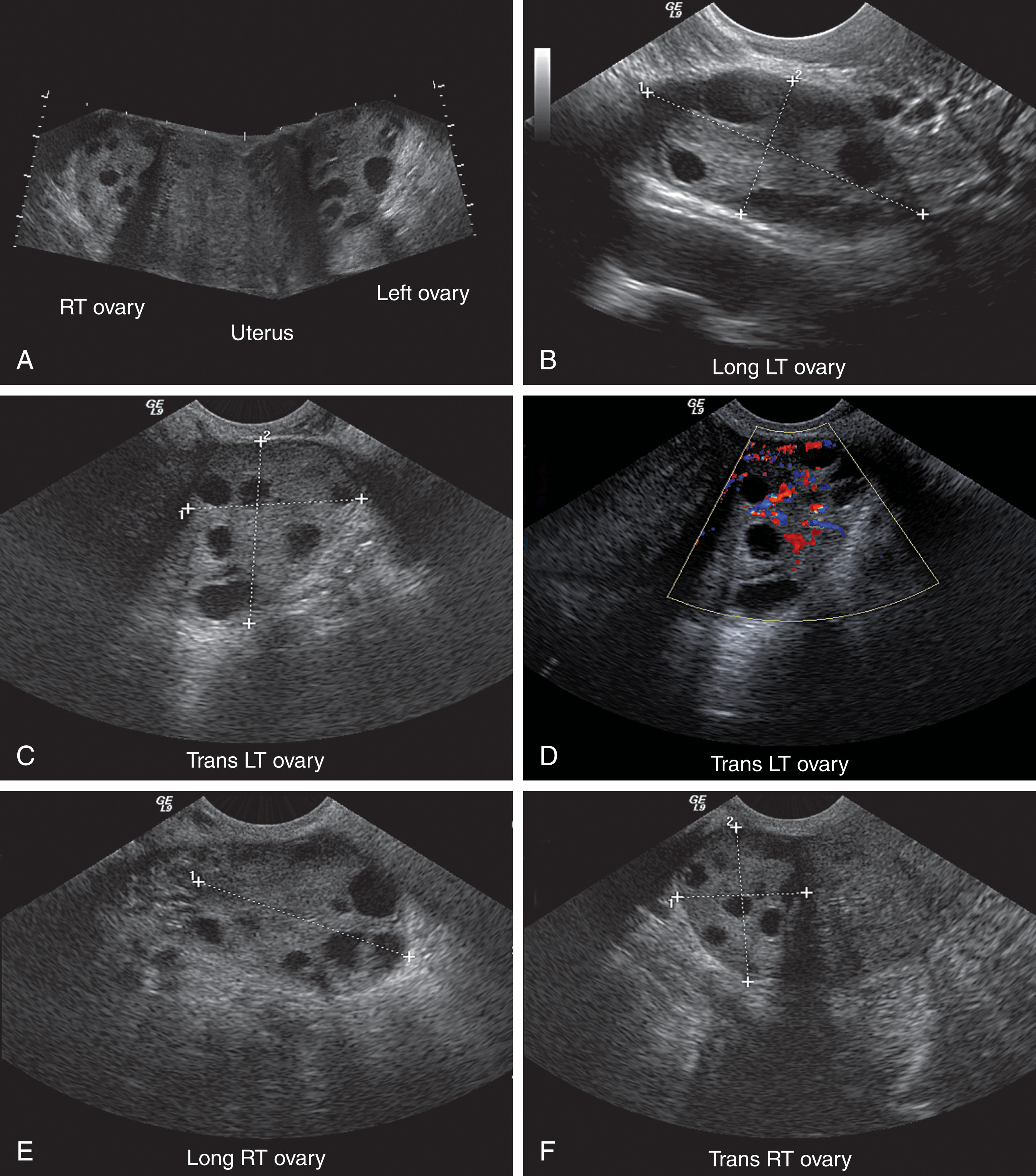 Fig. 44.2, Normal transvaginal image of the ovaries with multiple follicles