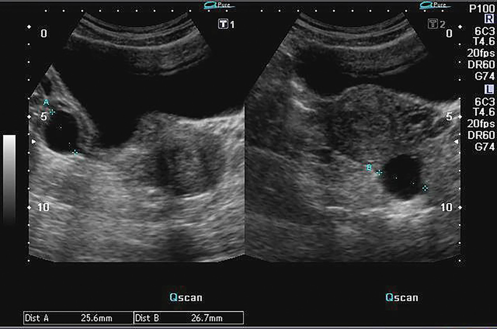 Fig. 44.4, A follicular cyst develops if the fluid in the nondominant follicles is not reabsorbed. Usually, the dominant follicle disappears immediately after rupture at ovulation.