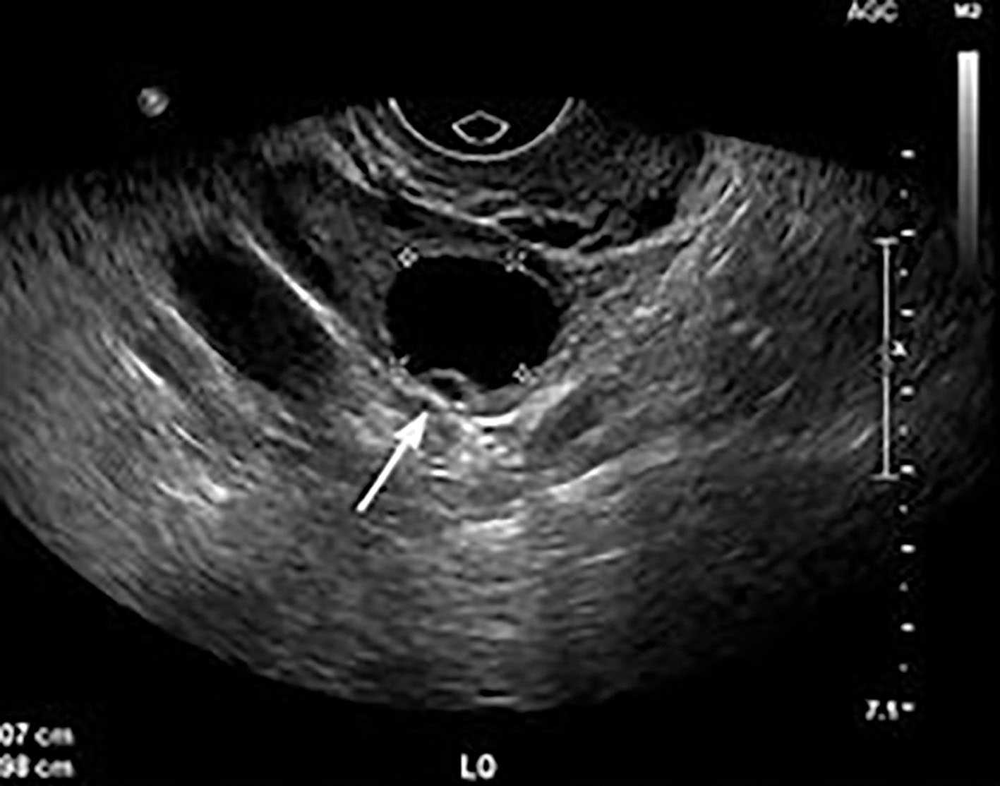 Fig. 44.7, The majority of ovarian masses are simple cysts, most of which are benign. Sonographic criteria for a simple cyst include a thin, smooth wall, anechoic contents, and acoustic enhancement.