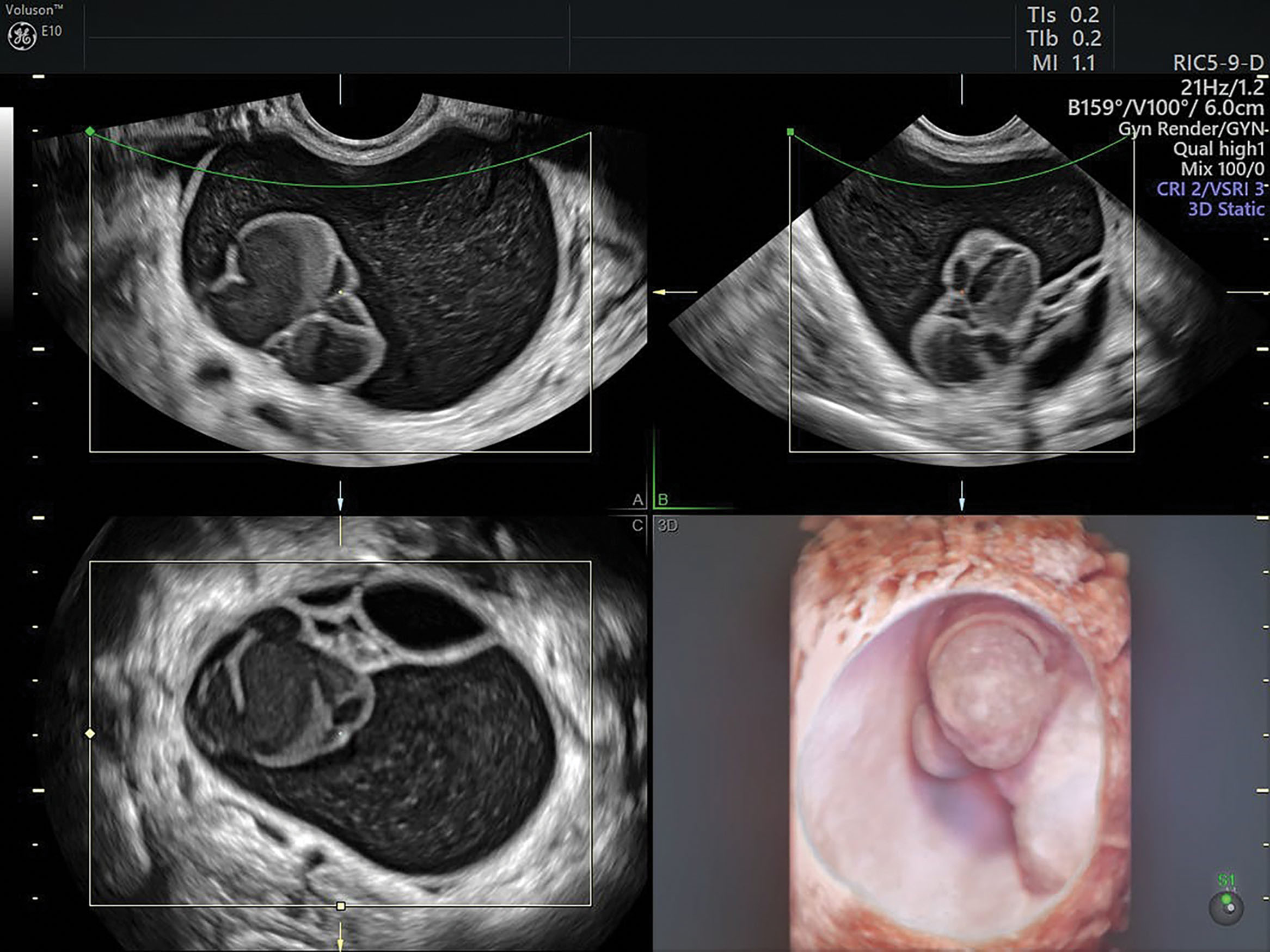 Fig. 44.8, Surgery is generally recommended for postmenopausal cysts greater than 5 cm and for those containing internal septations or solid nodules.