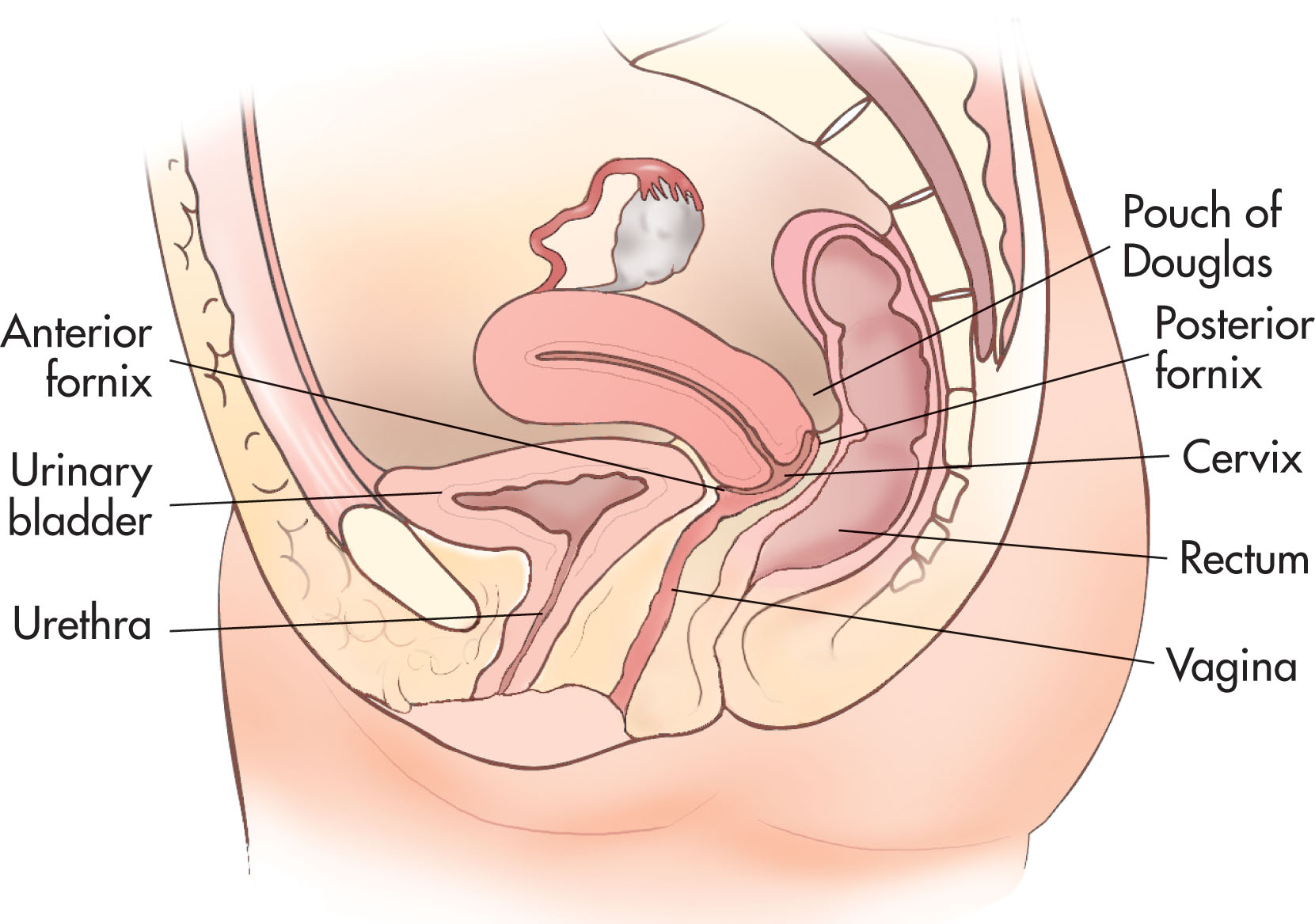 Fig. 43.1, Lateral view of the pelvis demonstrating the relationship of the pelvic organs to the bladder and pouch of Douglas.