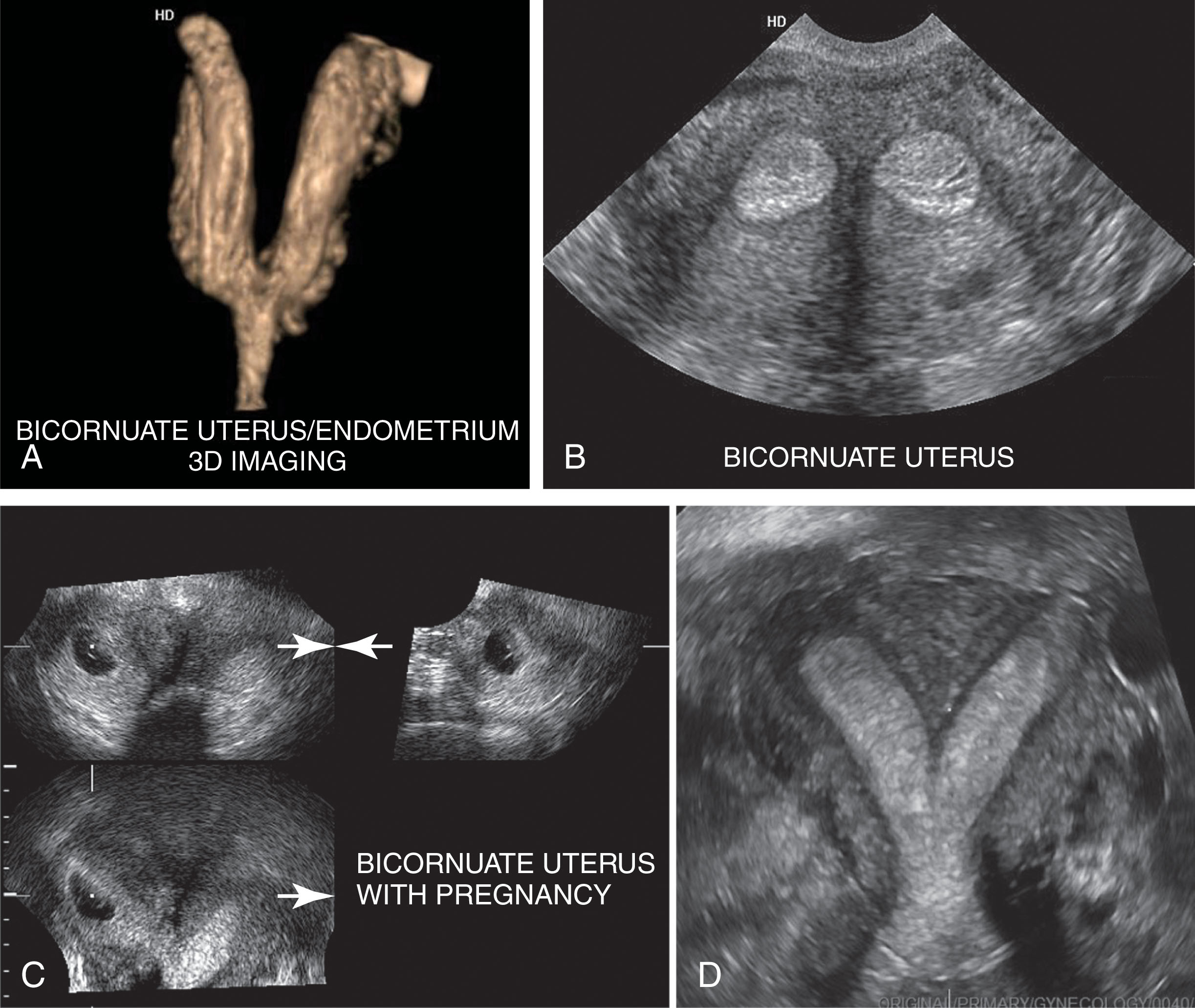 Fig. 43.11, Bicornuate uterus.