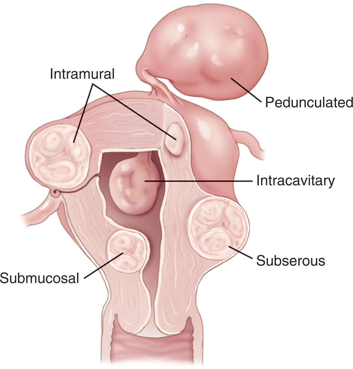 Fig. 43.13, Various locations of fibroid tumors found within the uterine cavity.