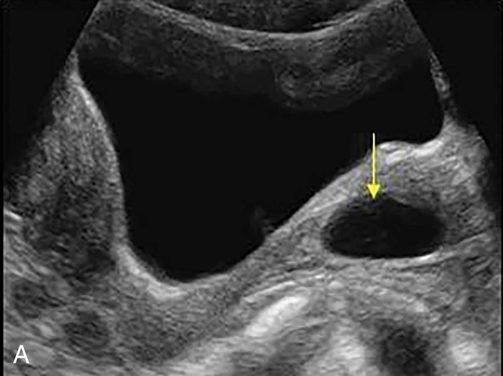 Fig. 43.2, (A) Gartner duct cysts are the most common cystic lesions of the vagina and usually are found incidentally during sonographic examination. (B) The most common congenital abnormality of the female genital tract is an imperforate hymen that results in obstruction that may result in an accumulation of fluid (hydrometra), blood (hematometra), or pus (pyometra).