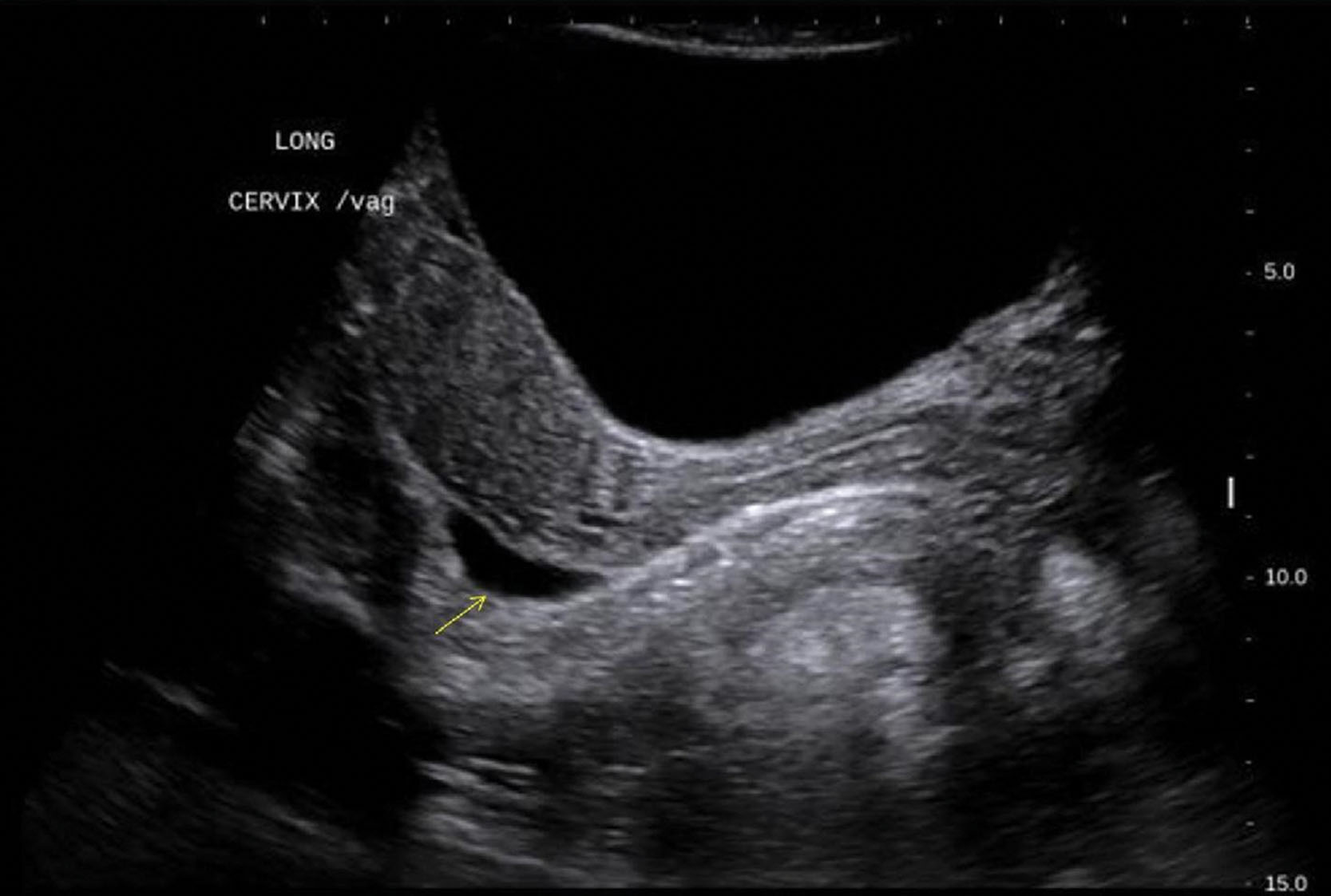 Fig. 43.3, The rectouterine recess (posterior cul-de-sac) is the most posterior and inferior reflection of the peritoneal cavity and is located between the rectum and uterus (also called the pouch of Douglas). Because of its location, it is frequently the site of intraperitoneal fluid collections. Pathologic fluid collections may be associated with ascites, blood resulting from a ruptured ectopic pregnancy, hemorrhagic cyst, or pus resulting from an infection.