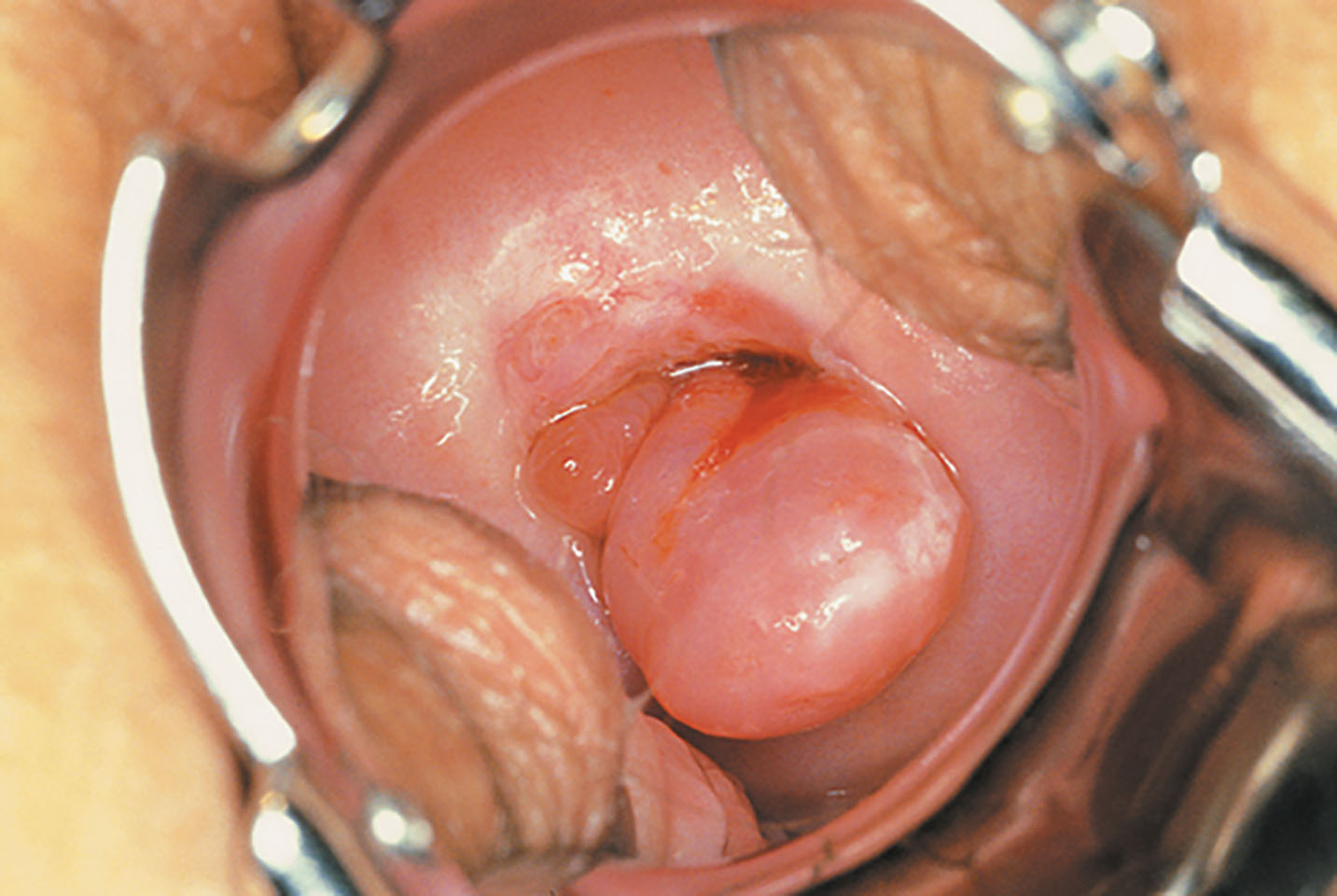 Fig. 43.5, The cervical polyps may be pedunculated, project out of the cervix, or be broad based; ultrasound may or may not detect them depending on their location.