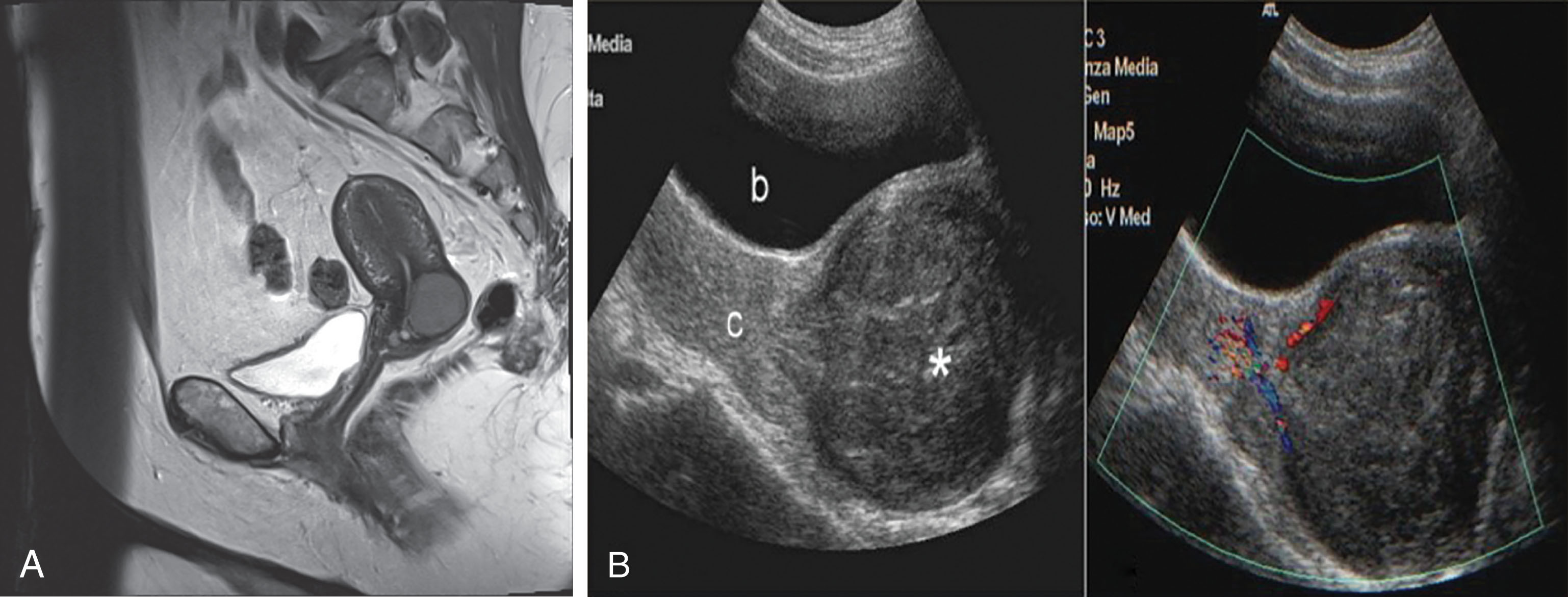 Fig. 43.6, (A) Magnetic resonance image of a small cervical leiomyoma. (B) A large intracavitary pedunculated myoma (asterisk) protrudes into the vagina from the cervical os. b , Bladder; c , cervix.