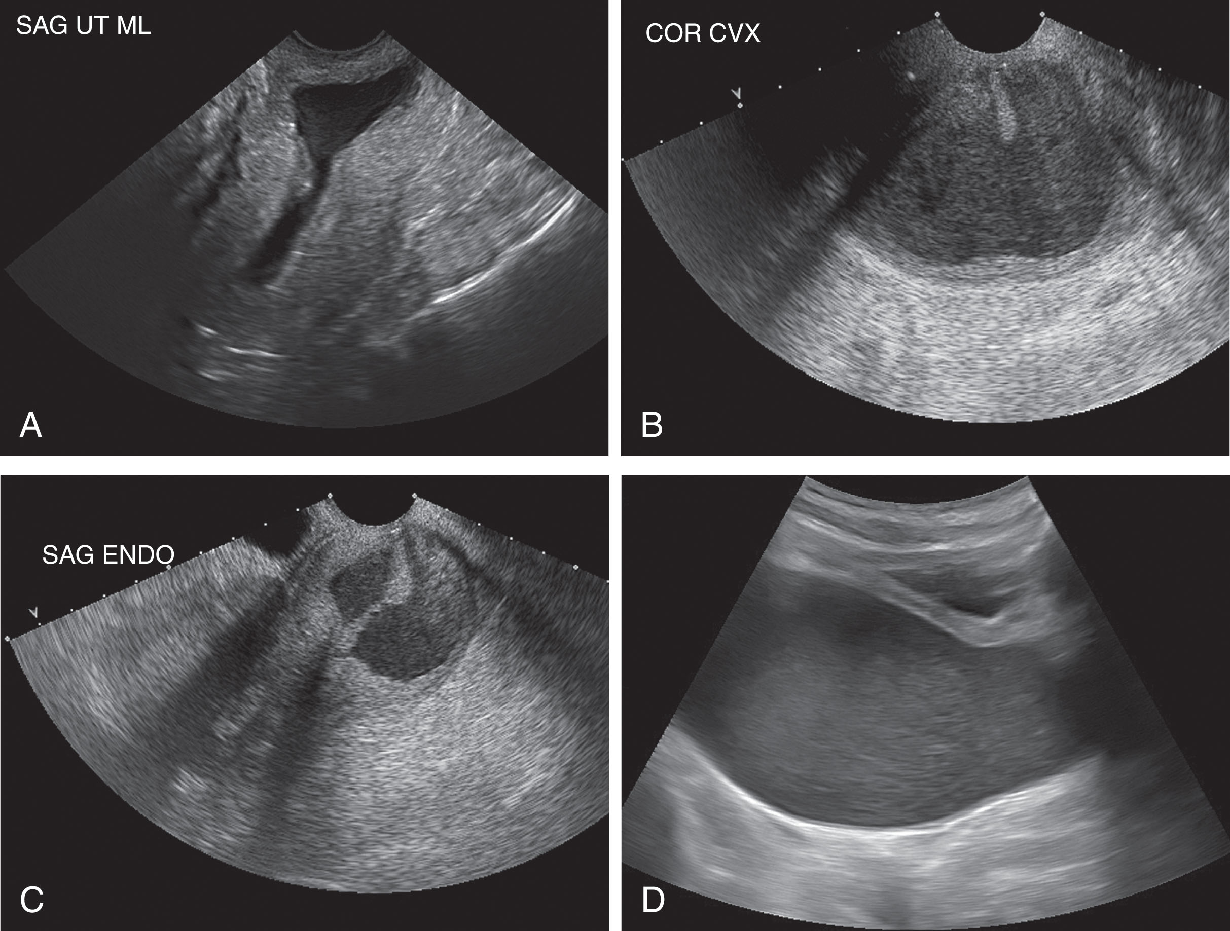 Fig. 43.7, (A–C) A 63-year-old asymptomatic woman on cyclic hormone replacement therapy demonstrates a large endometrial fluid collection. She underwent dilation for cervical stenosis, and bloody fluid was drained. (D) Hematometrocolpos presents as a moderately echogenic collection in the cervical area.